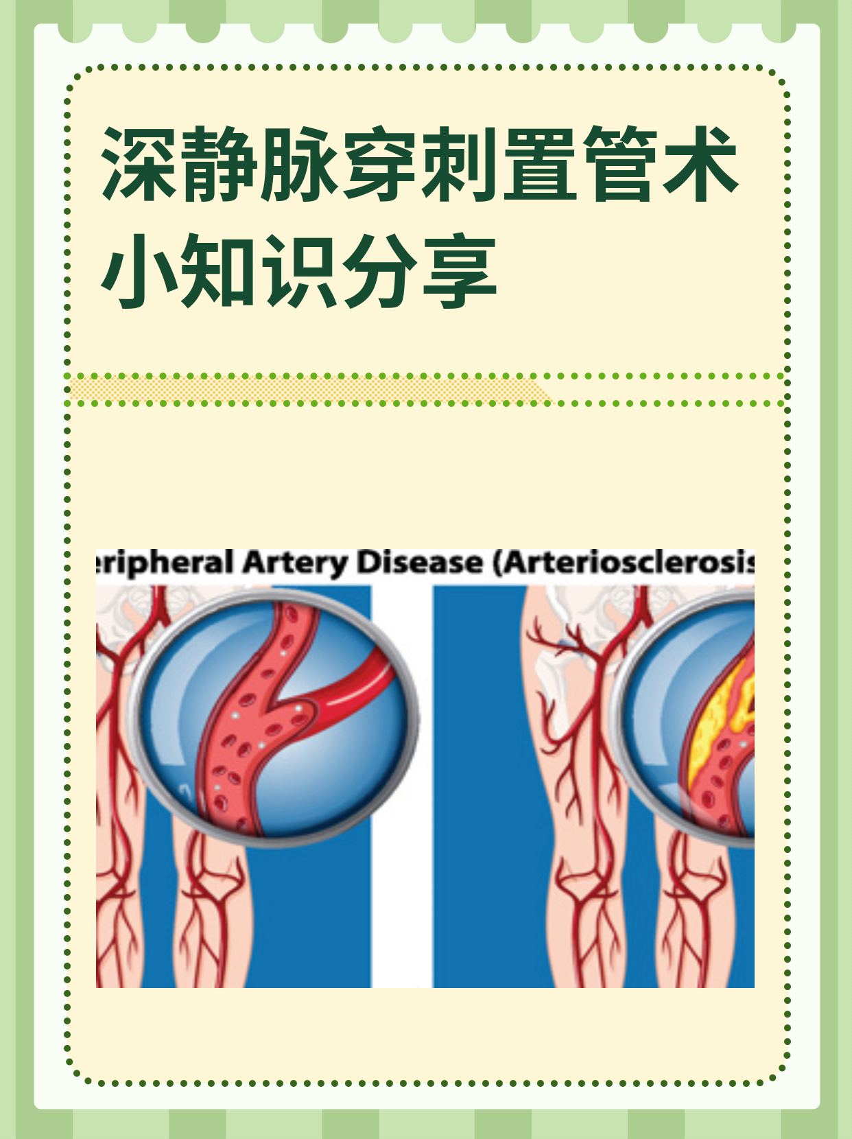 股静脉穿刺置管术图解图片