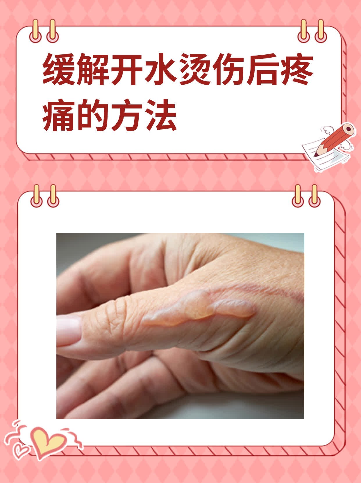 缓解开水烫伤后疼痛的方法