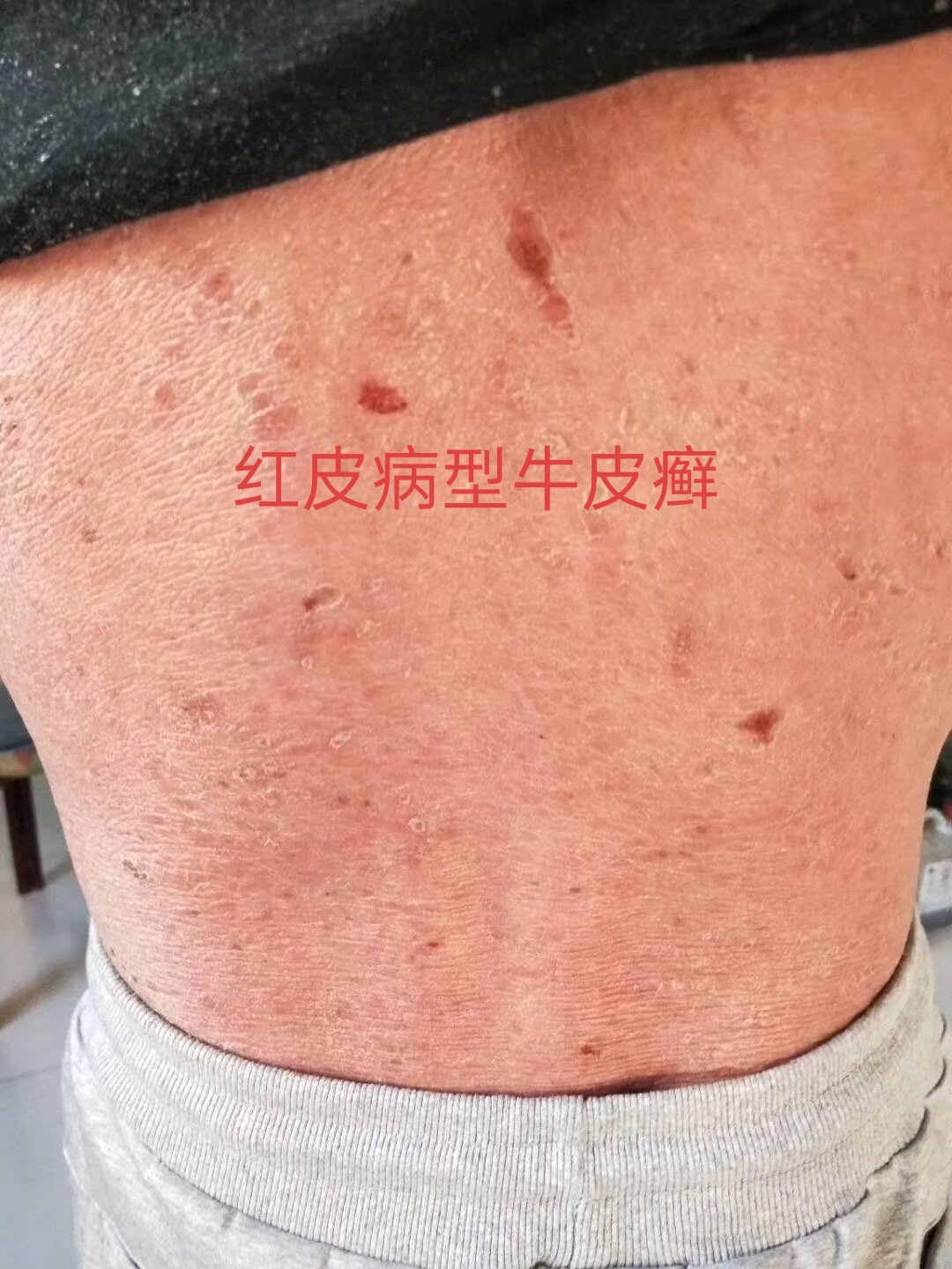 红皮病型牛皮癣