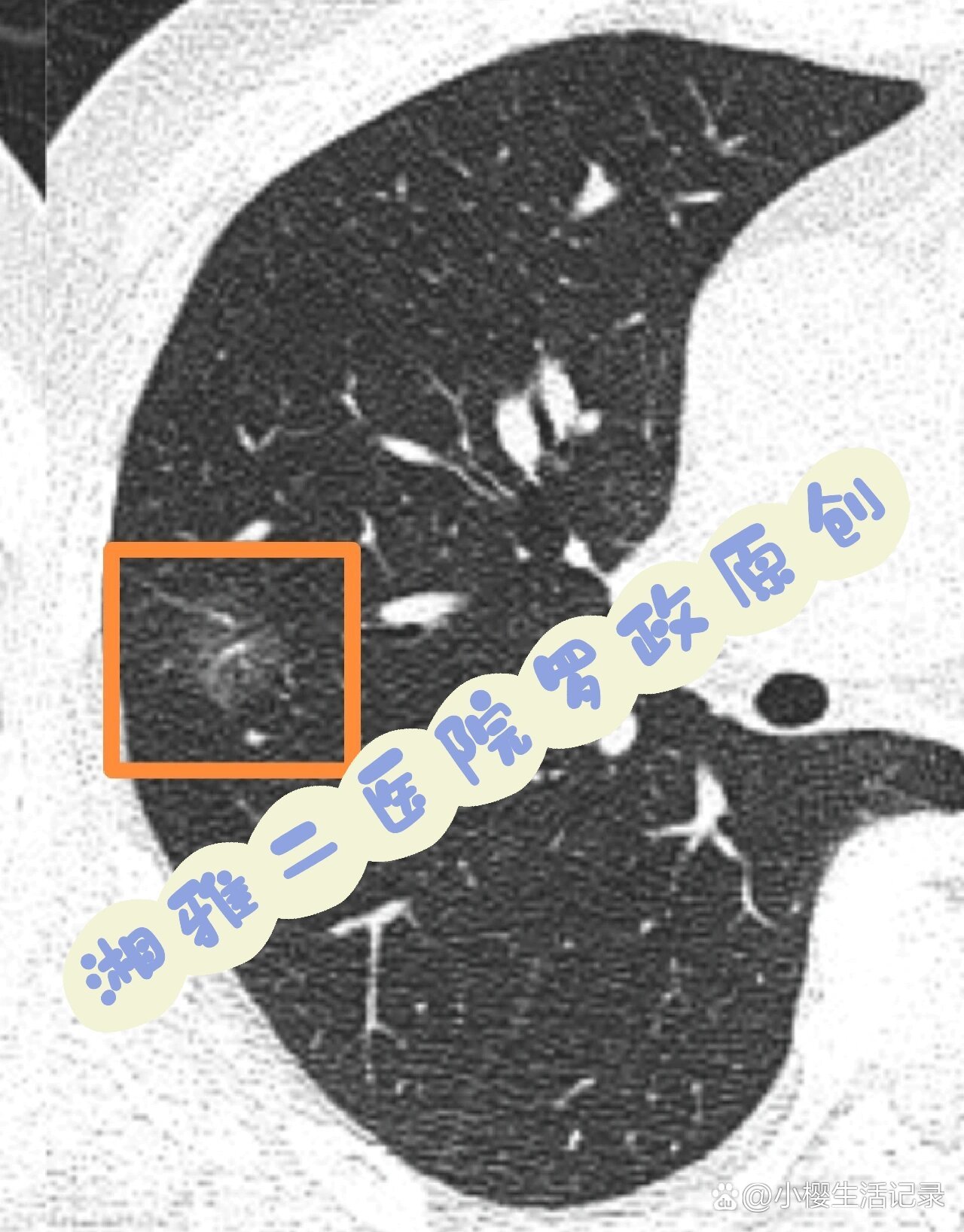 2公分磨玻璃结节血管穿行病理是良性增生