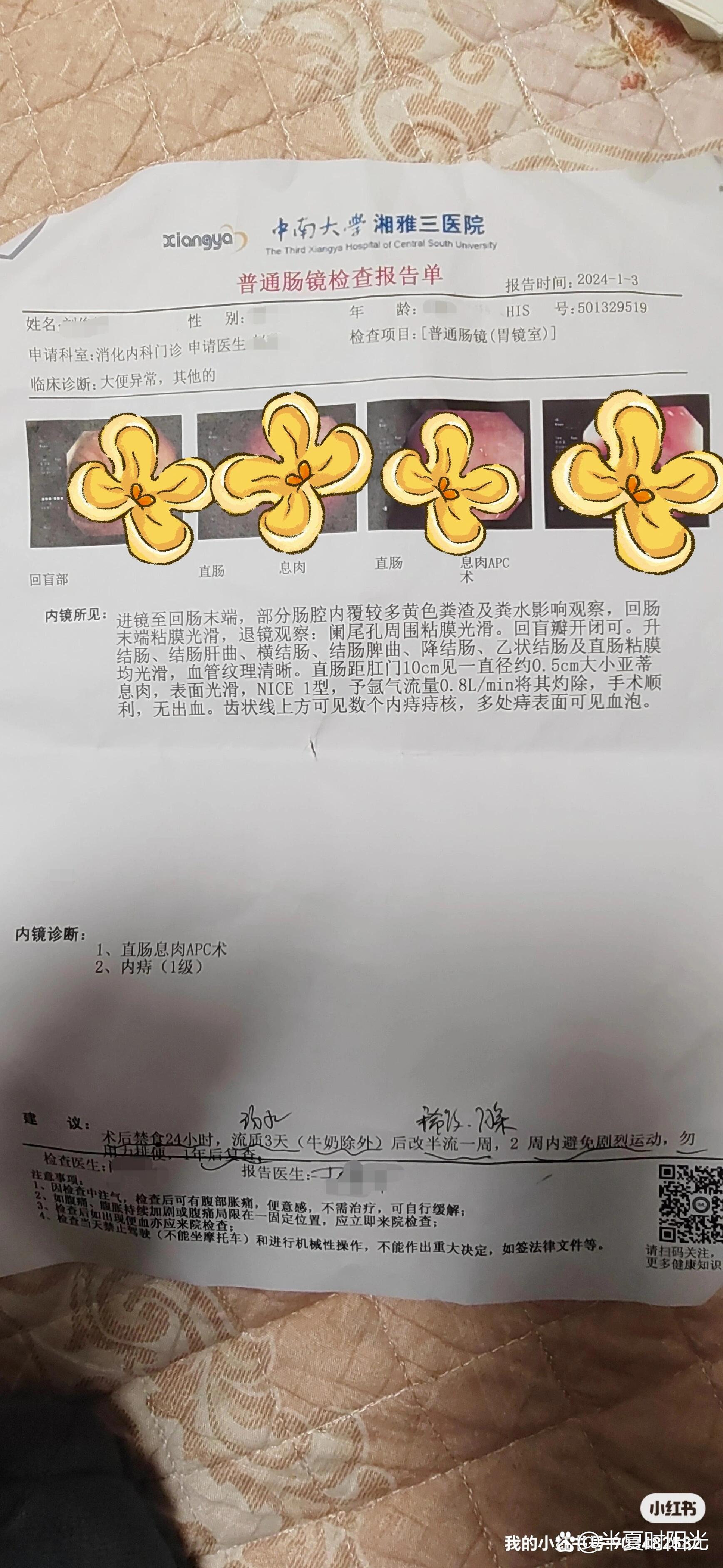 芍倍注射后痔疮脱落图片