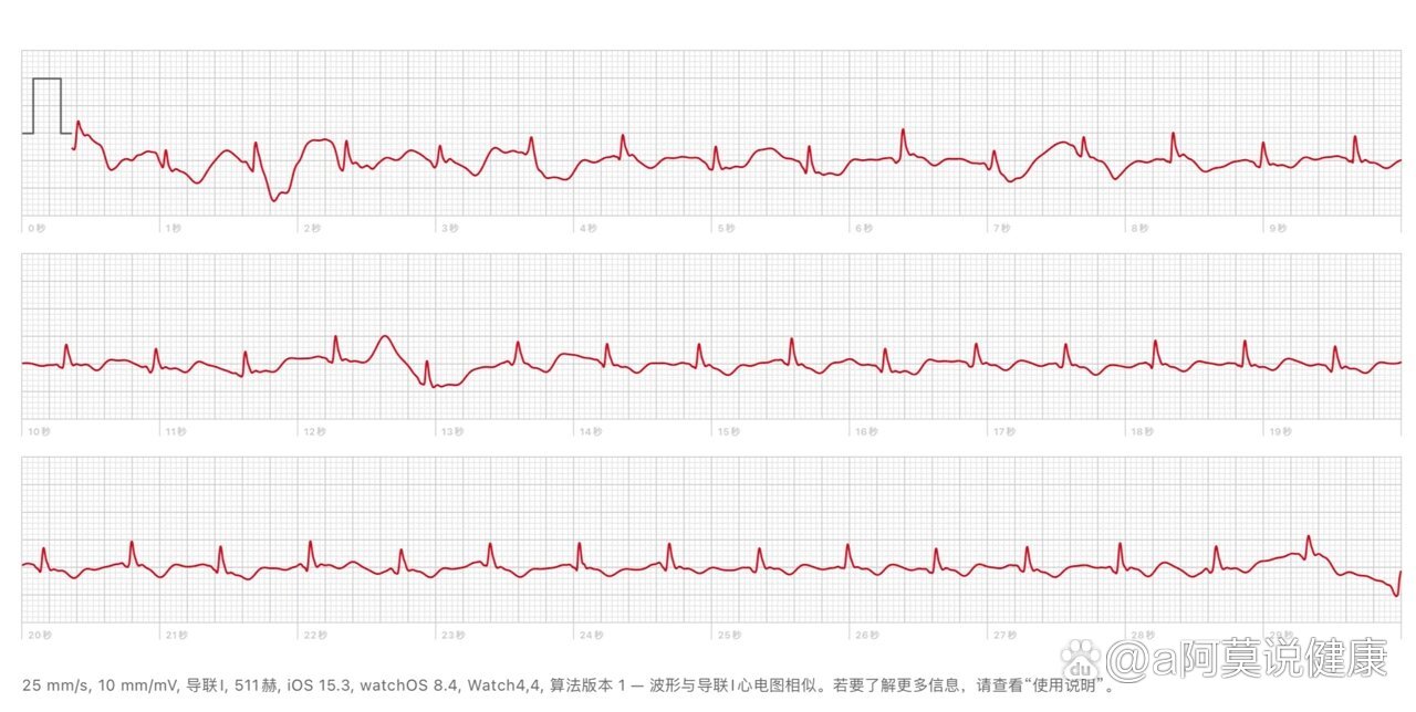 心电图6导联图片