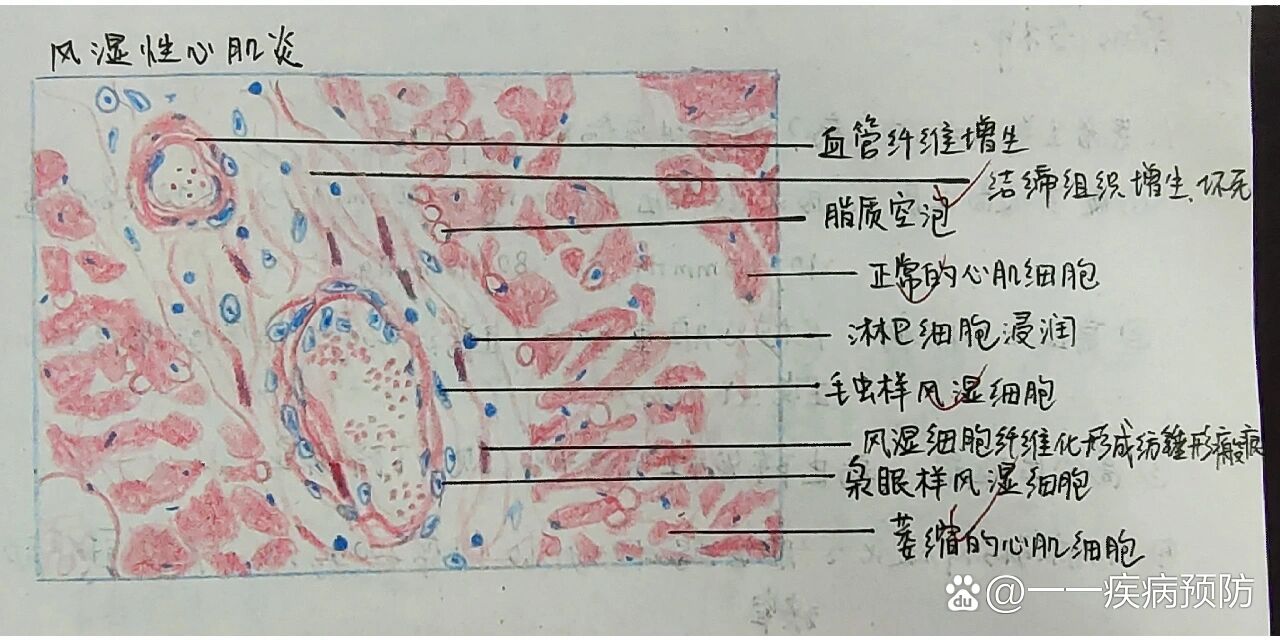 病理实验绘图——风湿性心肌炎