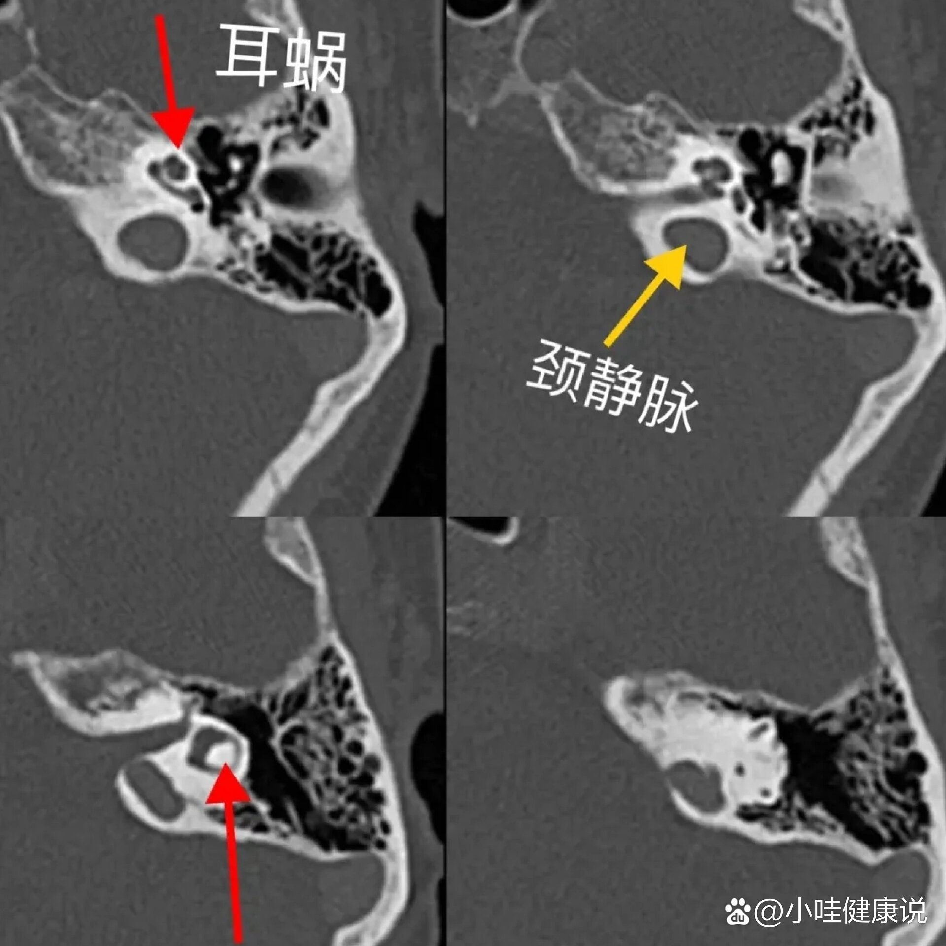 乙状窦骨壁缺损图片