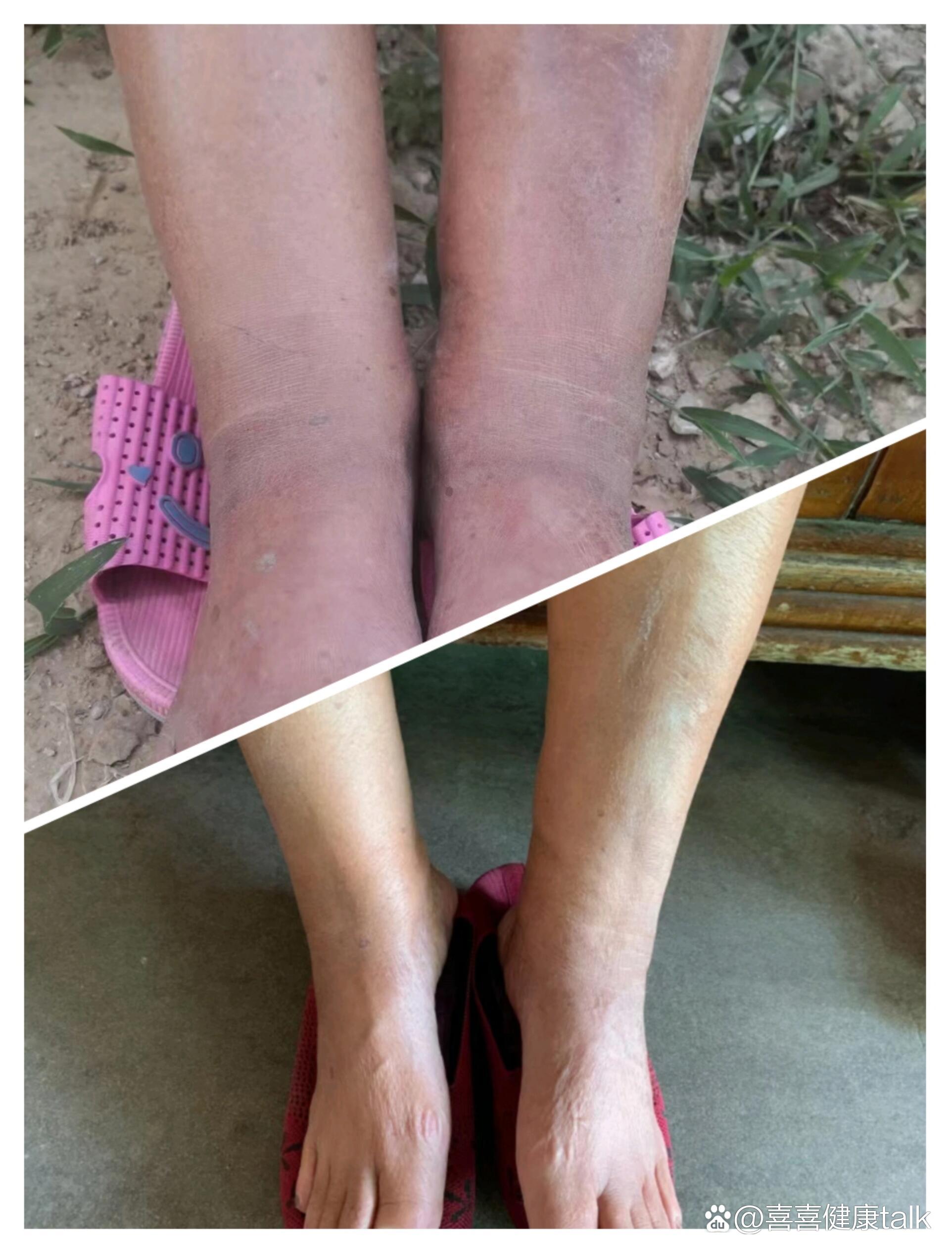 67下肢严重水肿