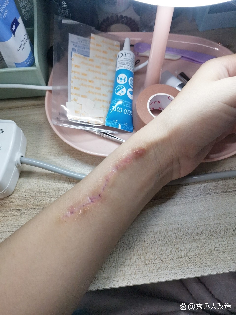 之前去拆线护士说可能会有一些没拆完的,会自己冒出来,让我到时候再去