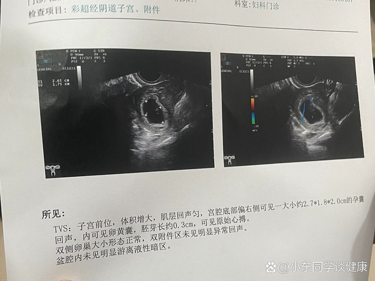 病理性缩复环超声图片图片