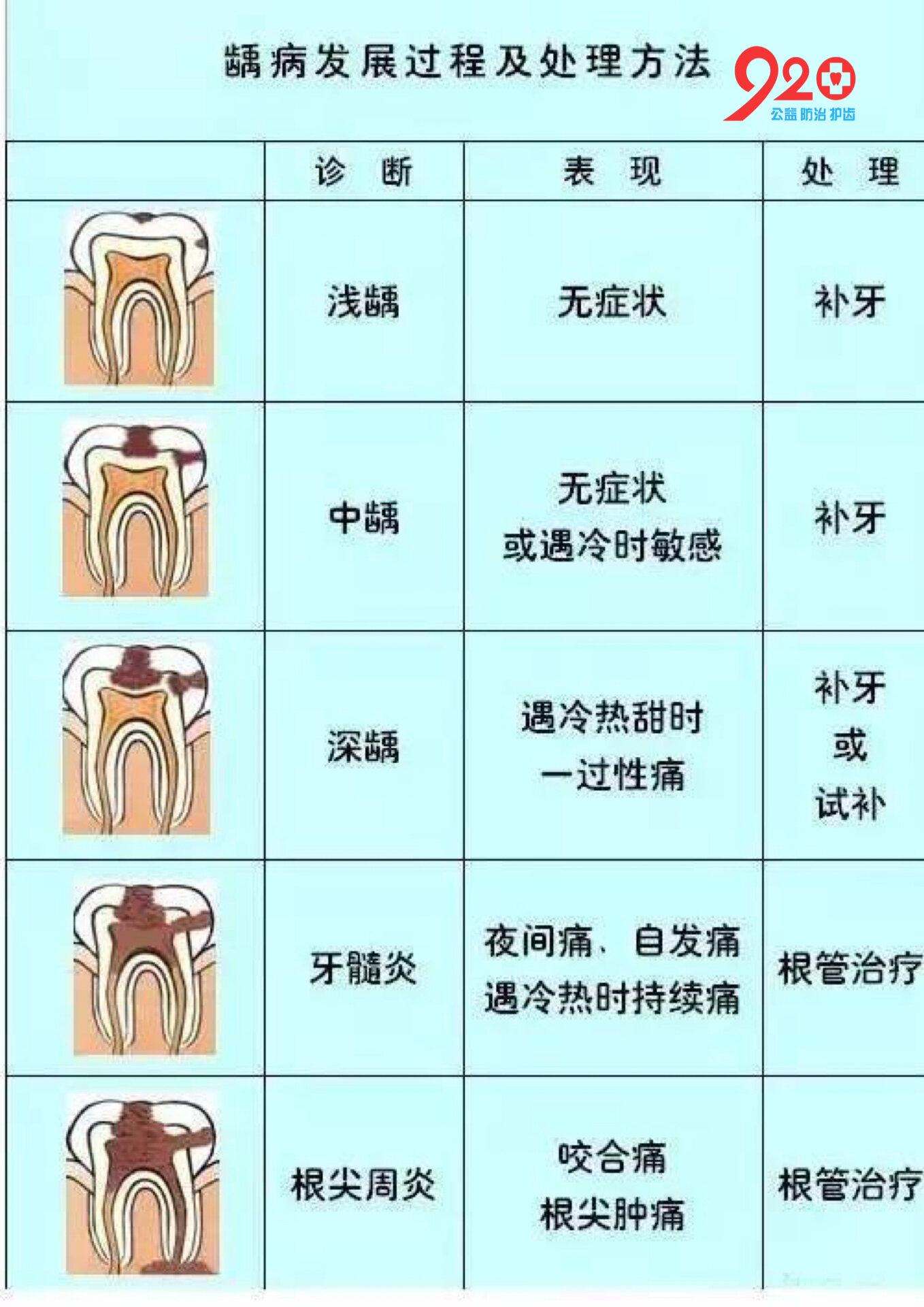 龋齿(蛀牙)发展全过程,你知道吗?