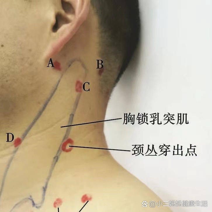 胸锁乳突肌外缘位置图图片