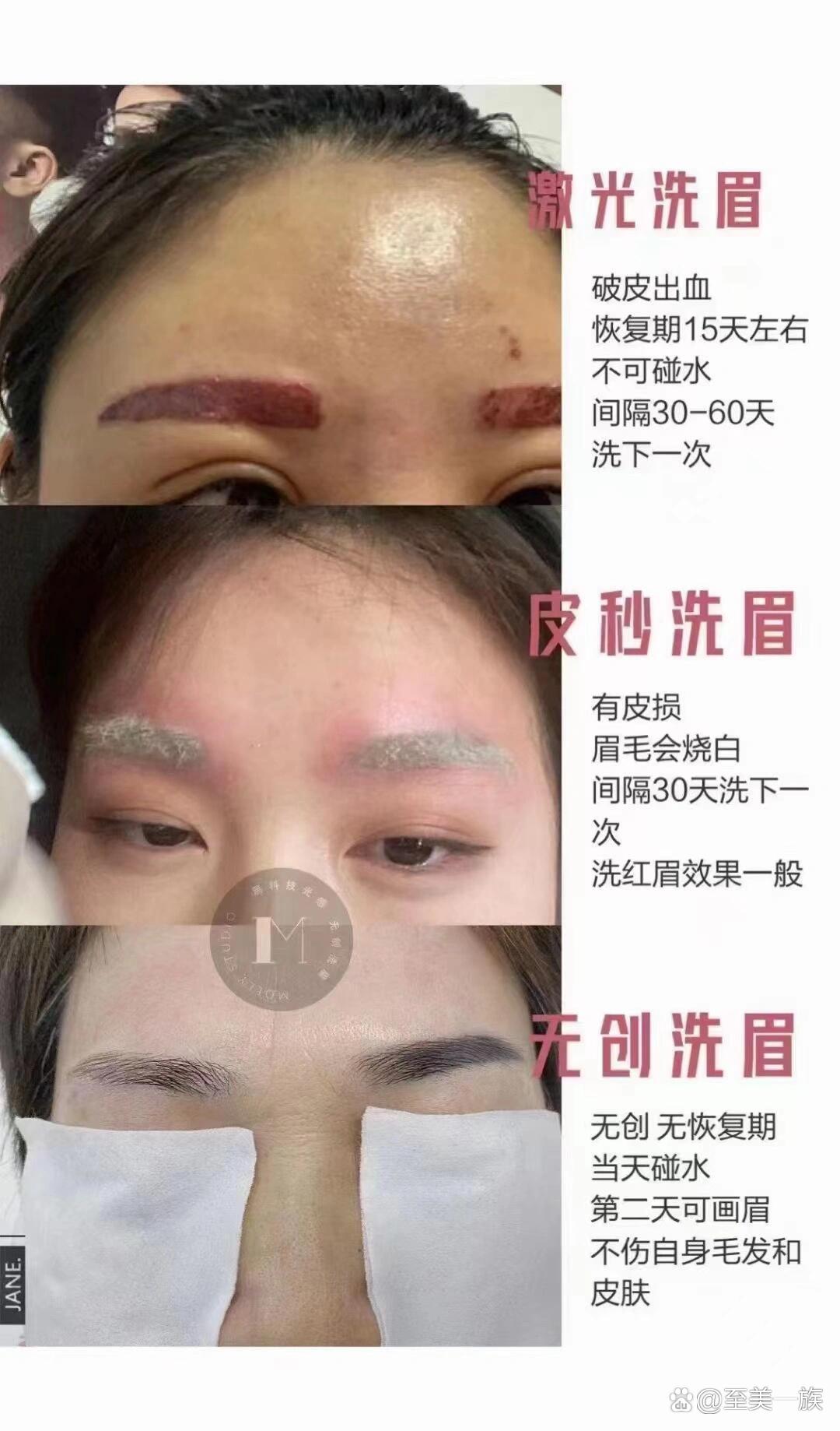 皮秒洗眉恢复过程图片图片