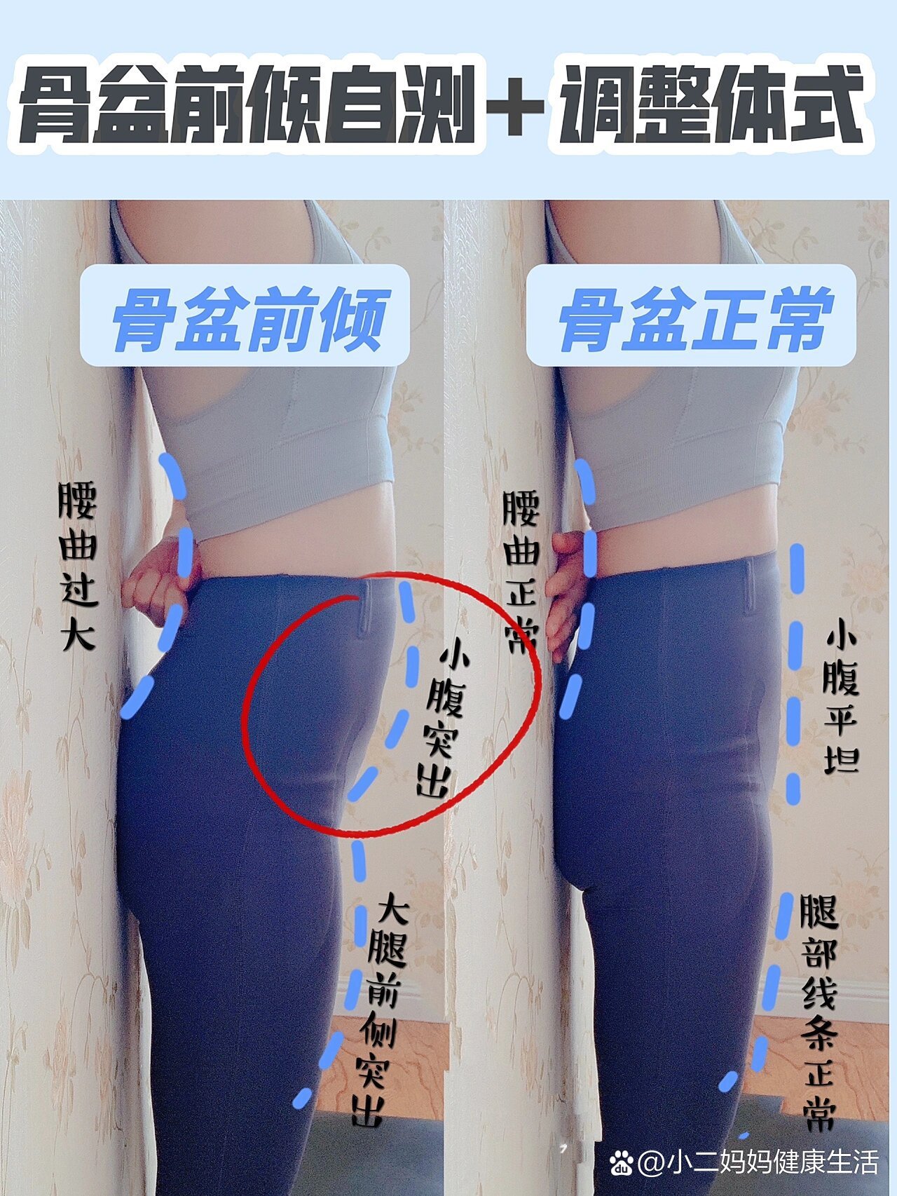 骨盆前倾自测方法✅如何避免❗️私教纠正体式