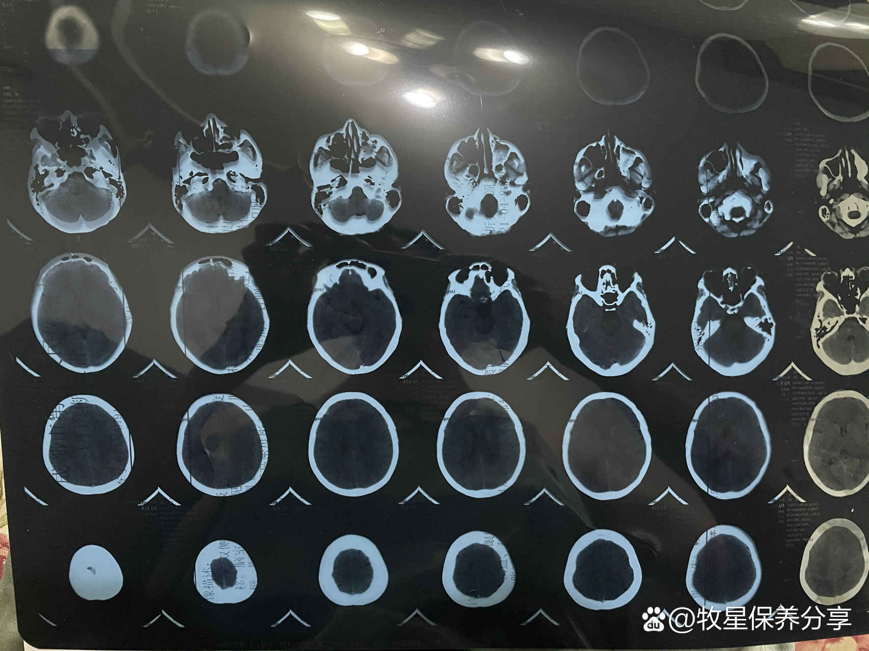 眉骨骨折图片ct图片