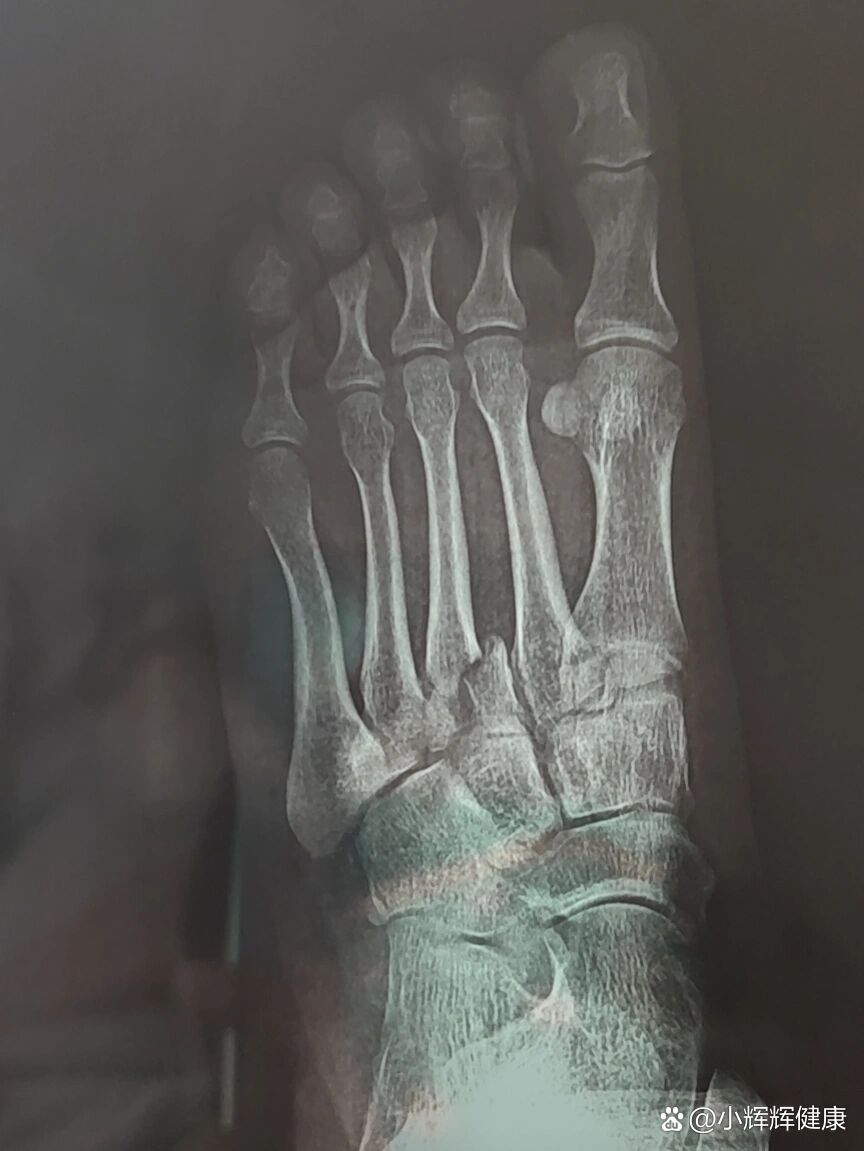 第三根骨头错位了,还需要动手术吗?