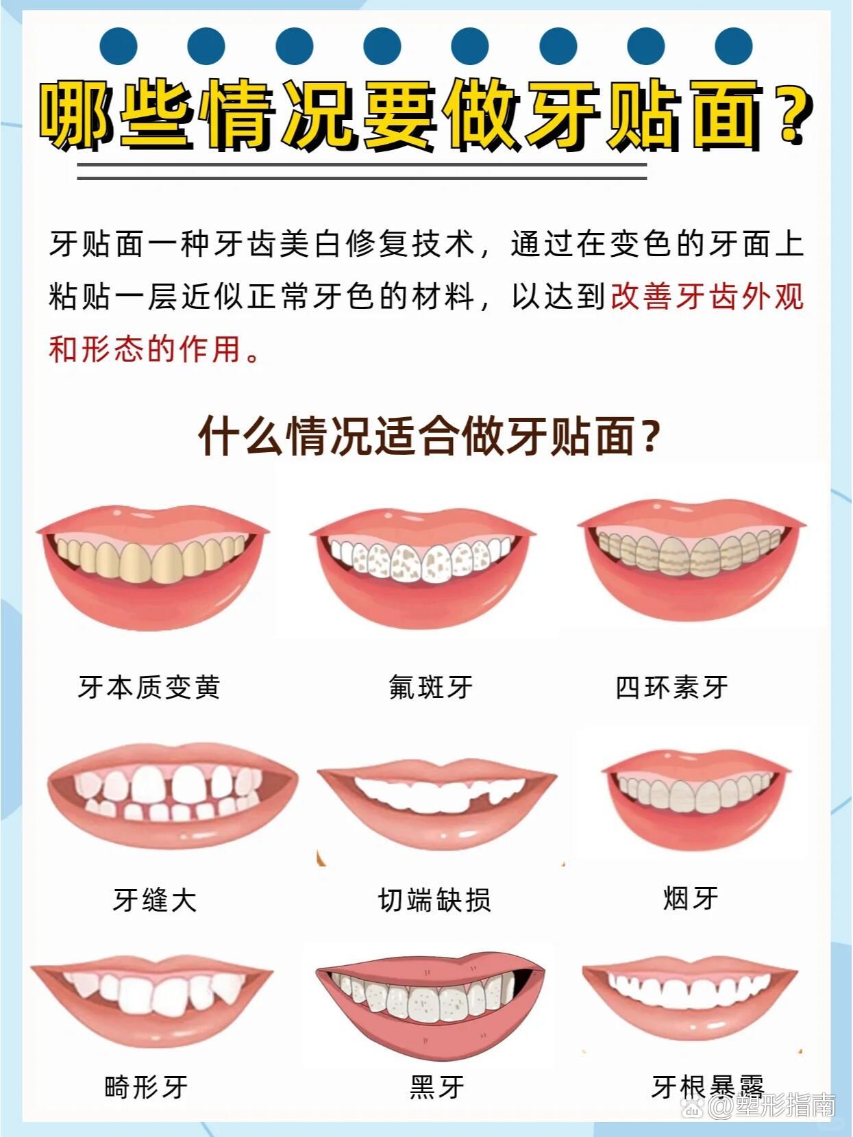 牙齿贴面揭秘:市面上牙齿贴面的种类及优点