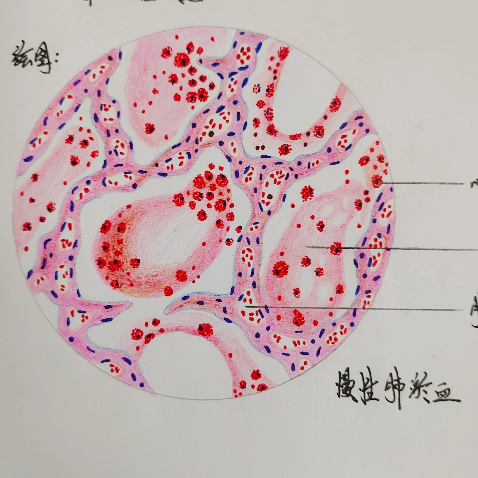 慢性肺淤血的镜下特点图片