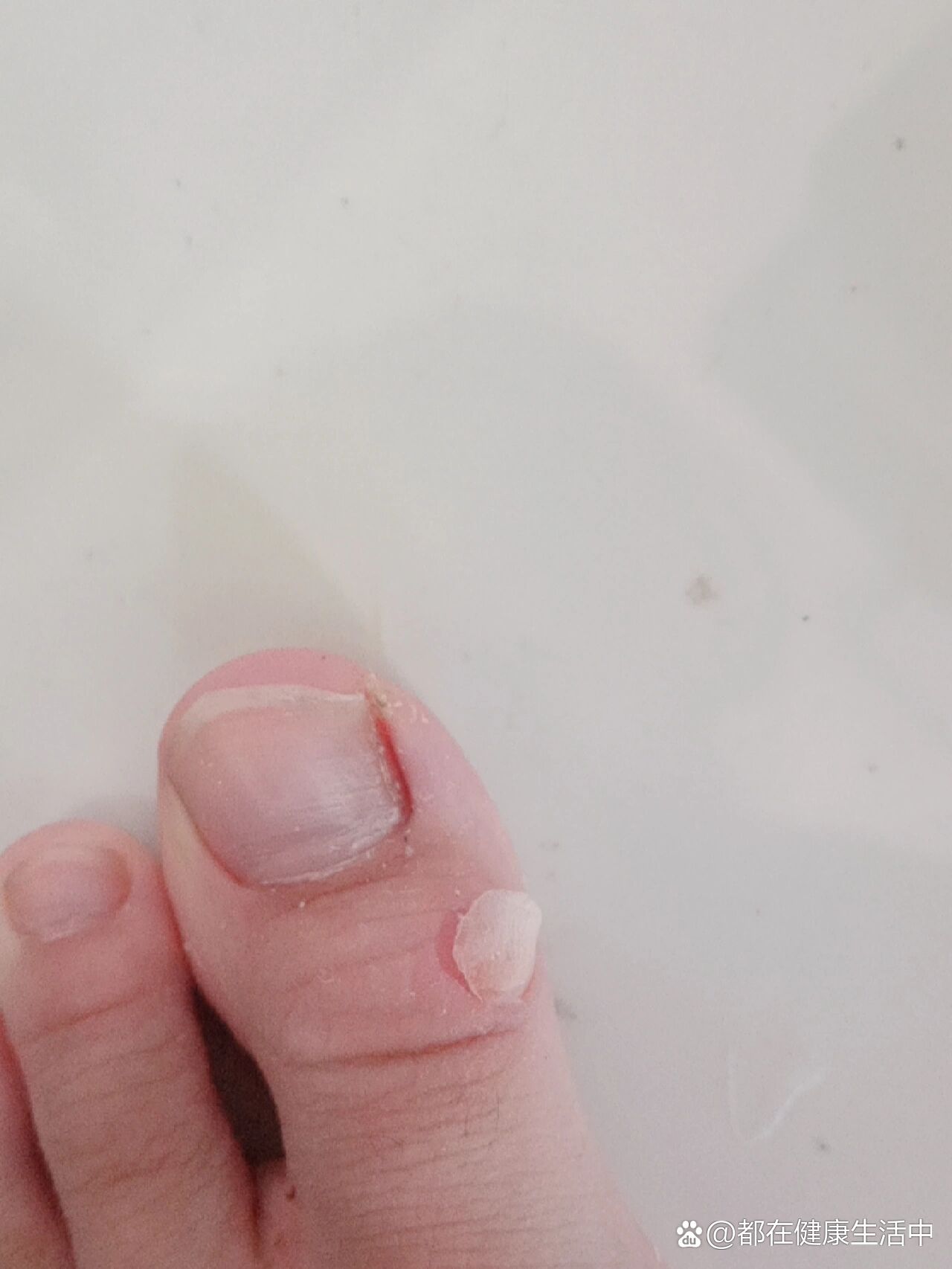 我的脚磨出水泡了,该怎么办?