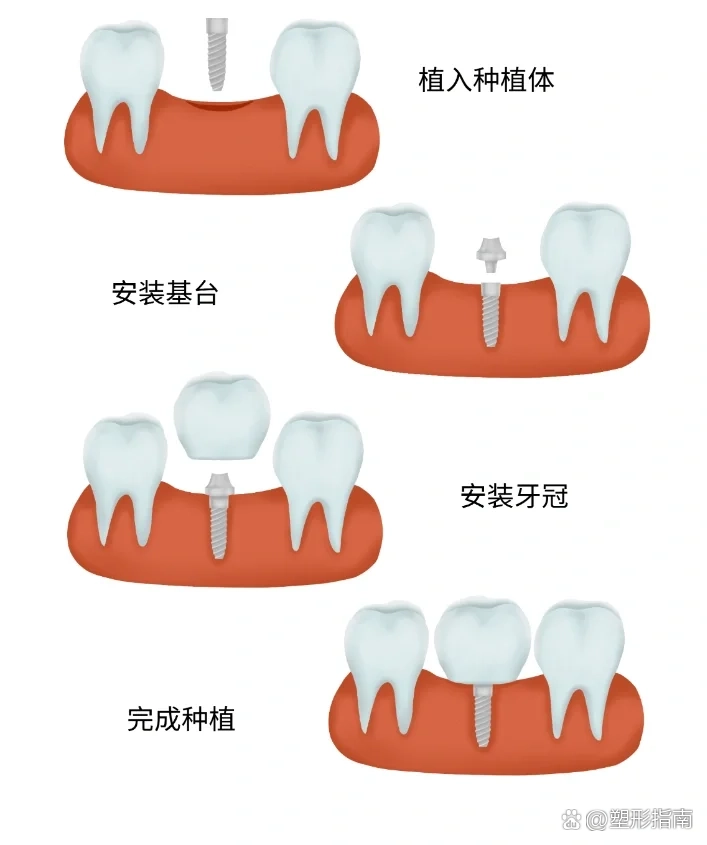 种植牙是缺几颗种几颗�