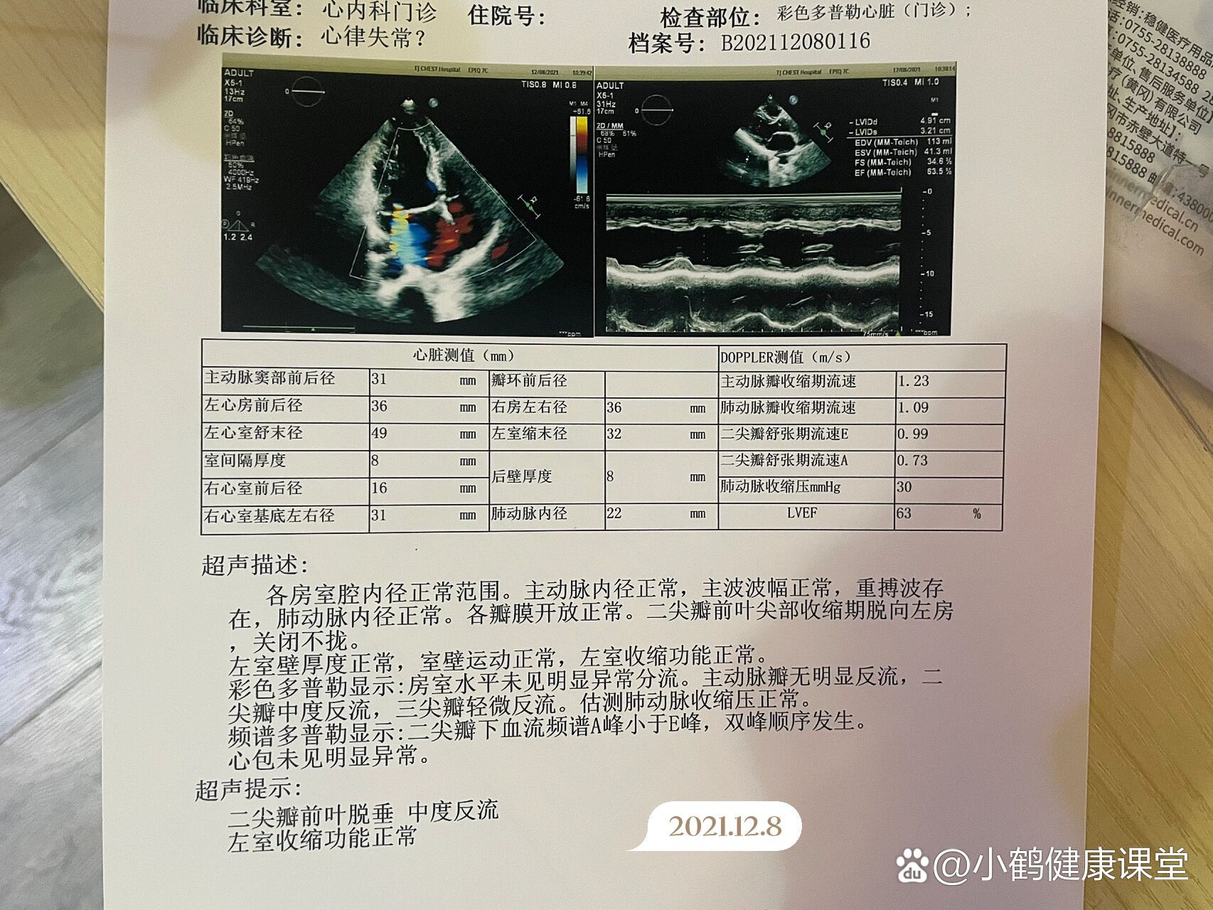 瓣膜脱垂图片