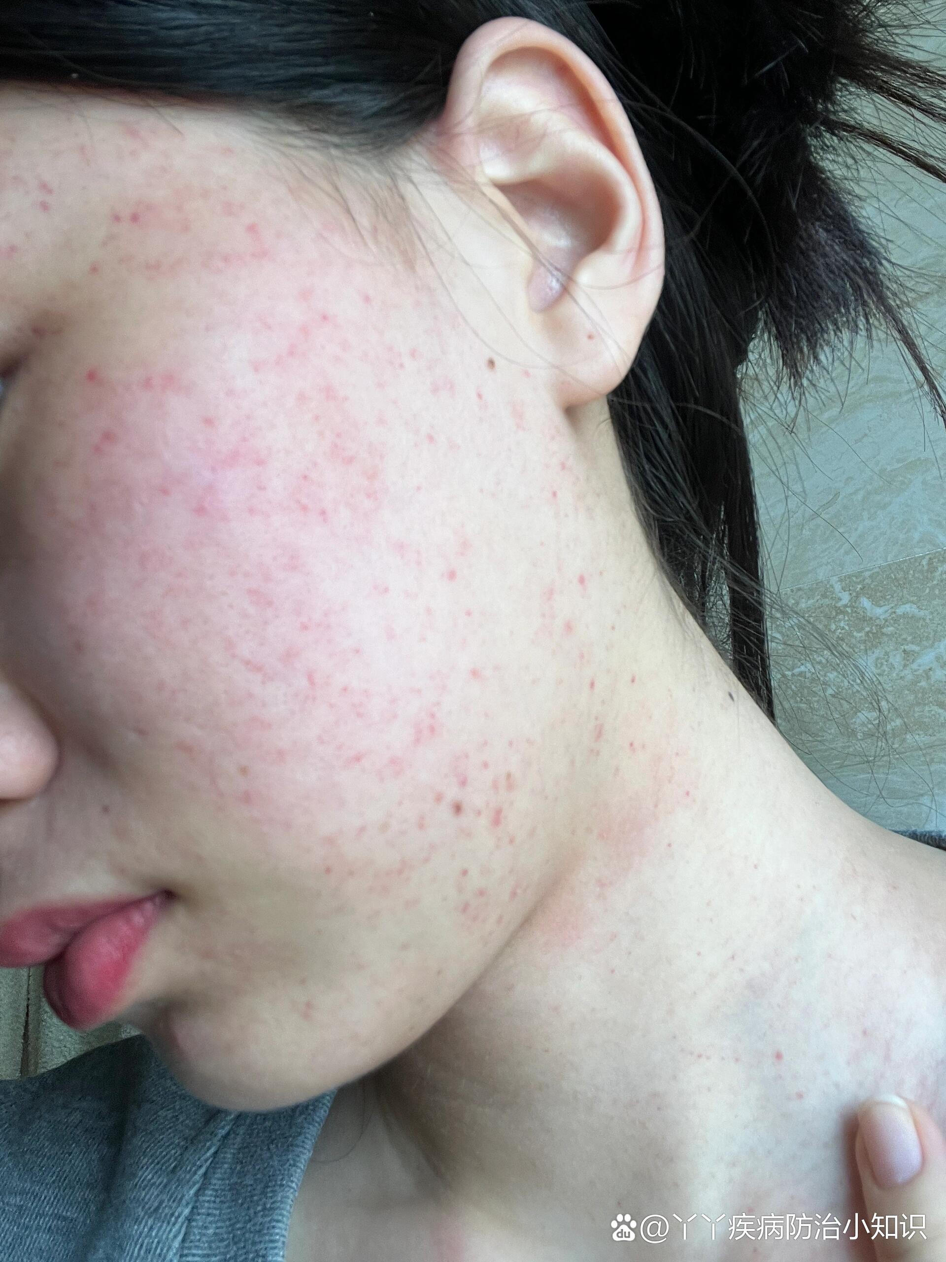 有谁和我一样孕期吐到毛细血管破裂