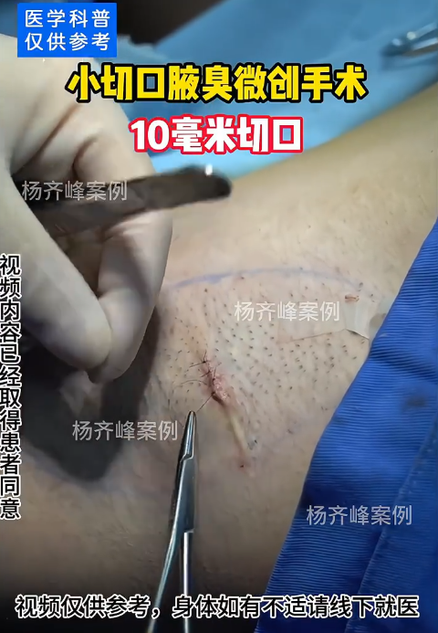  p>目前 手术治疗是解决腋臭的较好办法.