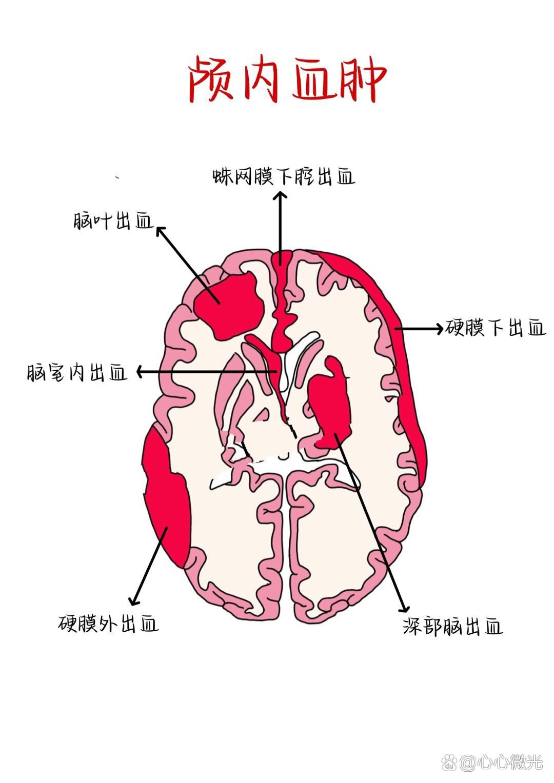 大脑额叶受损的症状图片