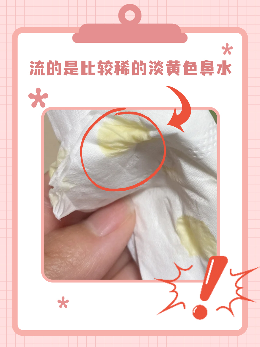 鼻子里面流黄水?不会是鼻窦囊肿破了吧?