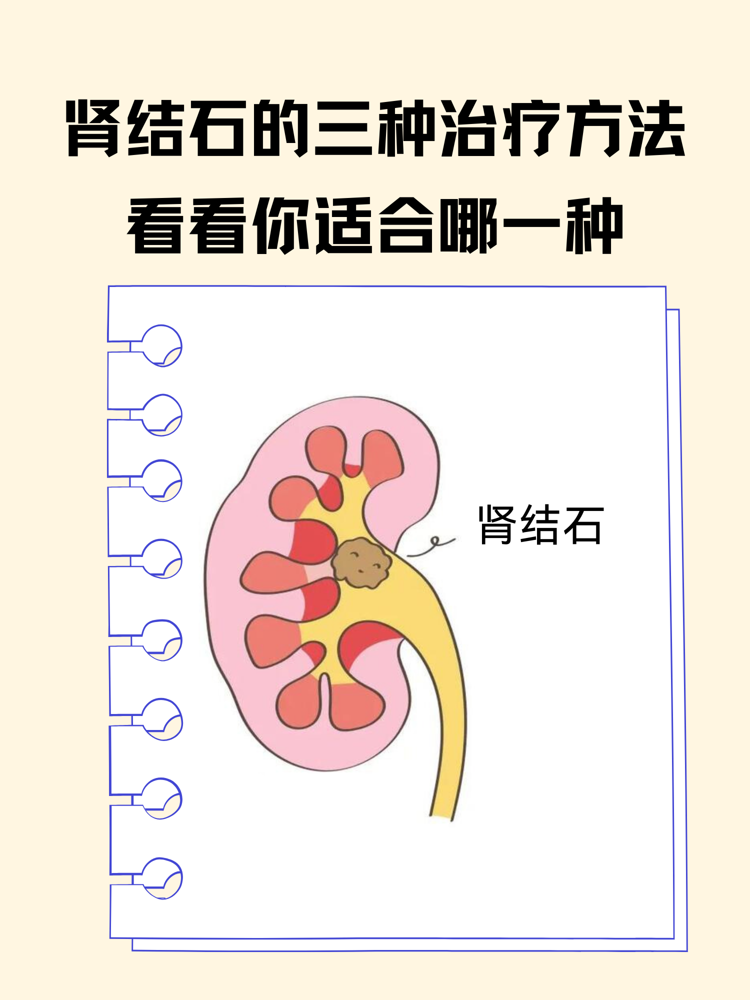 肾结石往下排的过程图图片