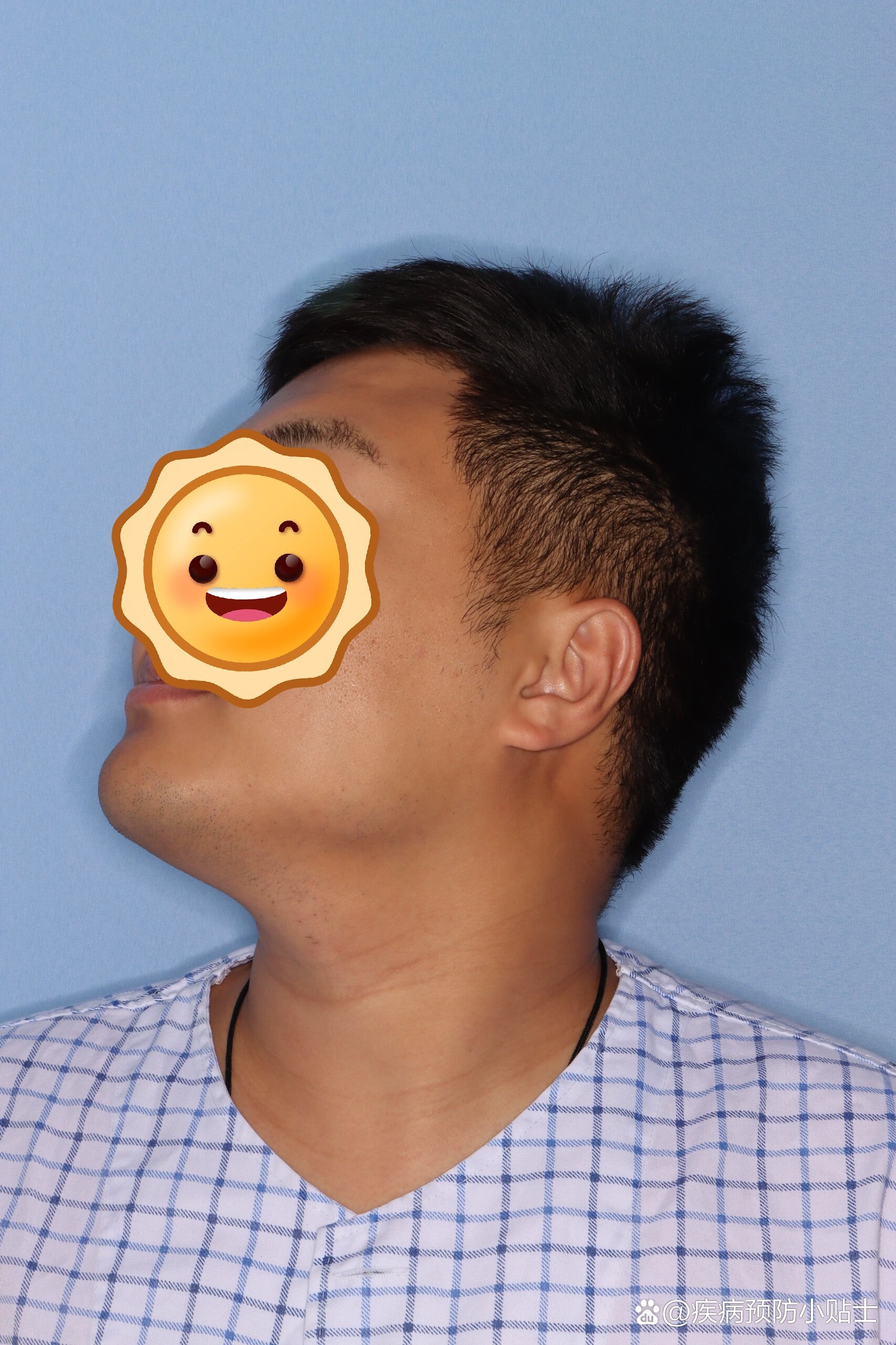 颌下腺肿瘤请去北大口腔找王威医生