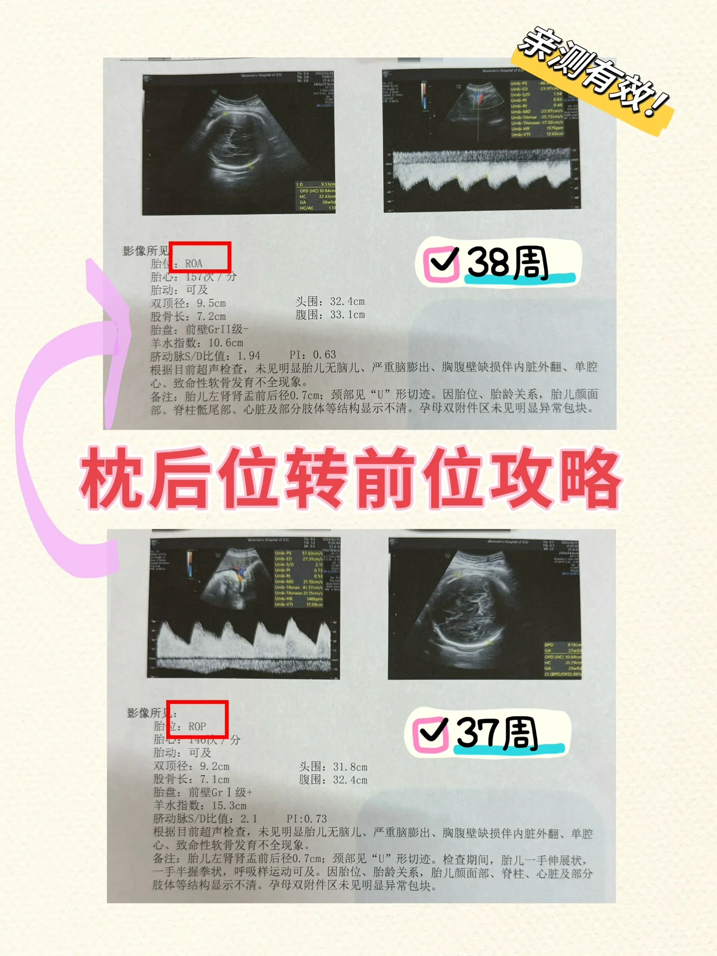 胎儿枕后位图片