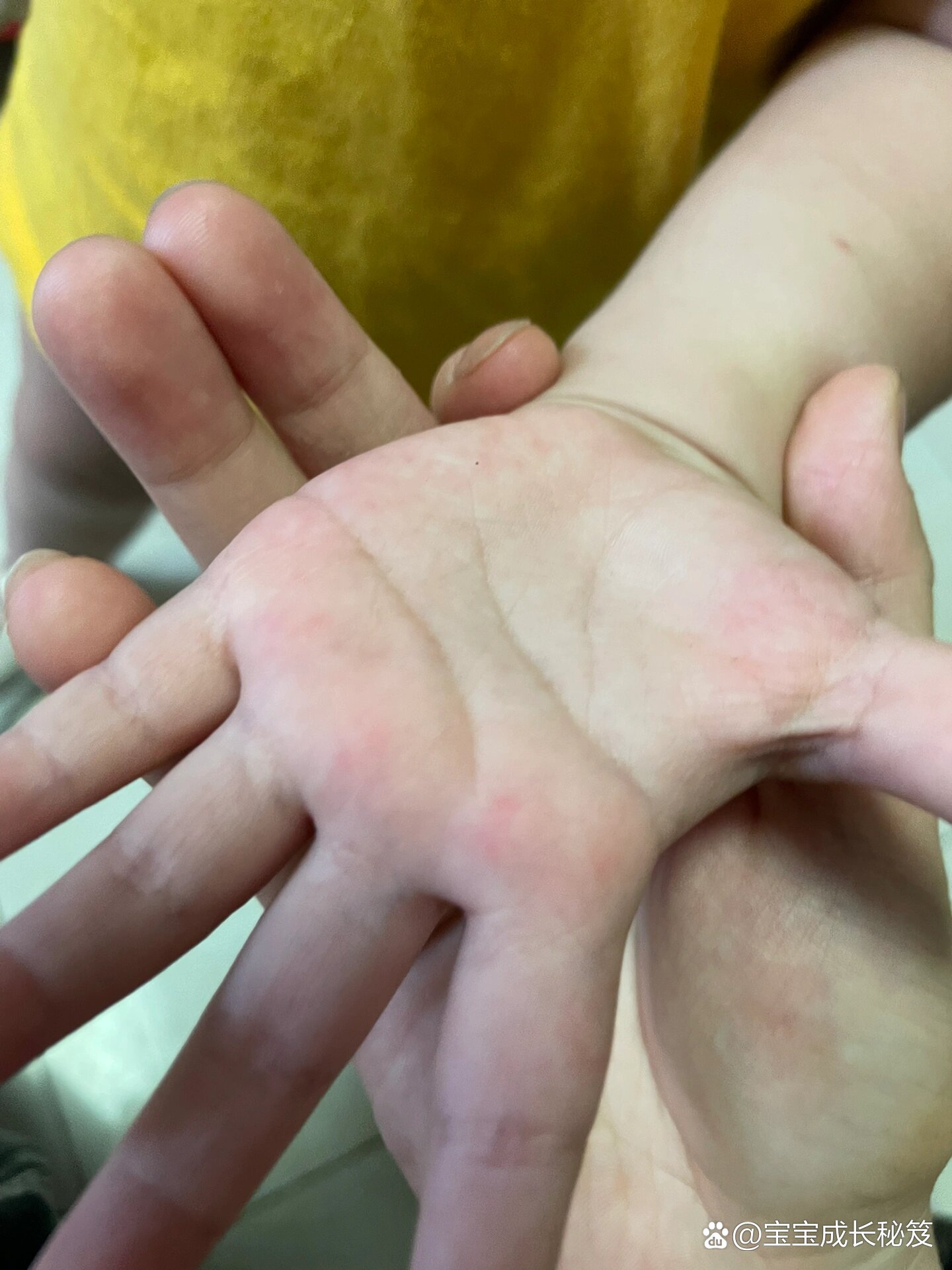 27个月宝宝手掌心有红点