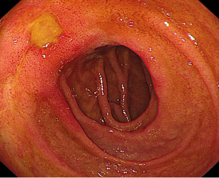 患者突发呕血,病因检查为十二指肠球部溃疡