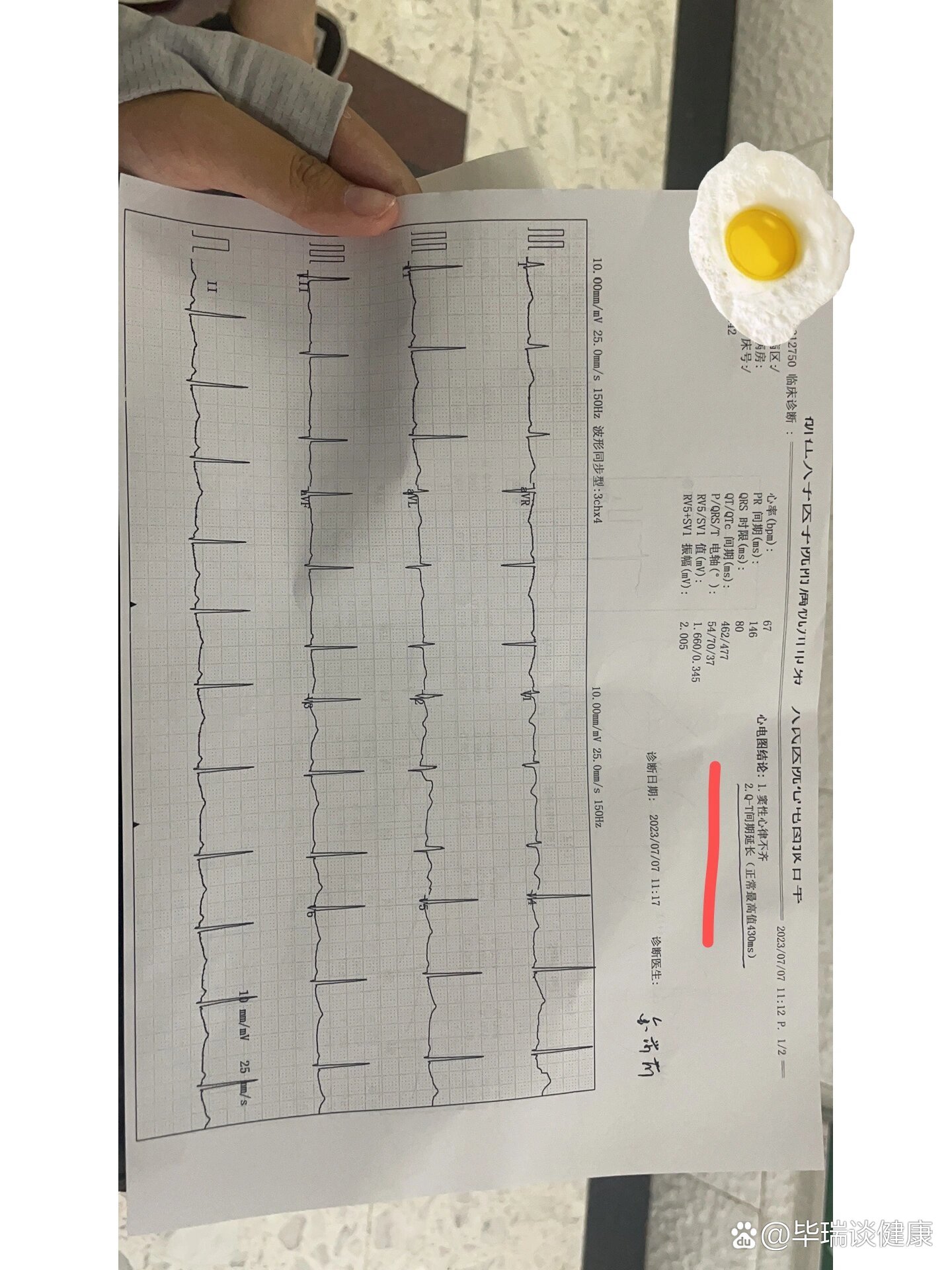 心电图qt间期延长