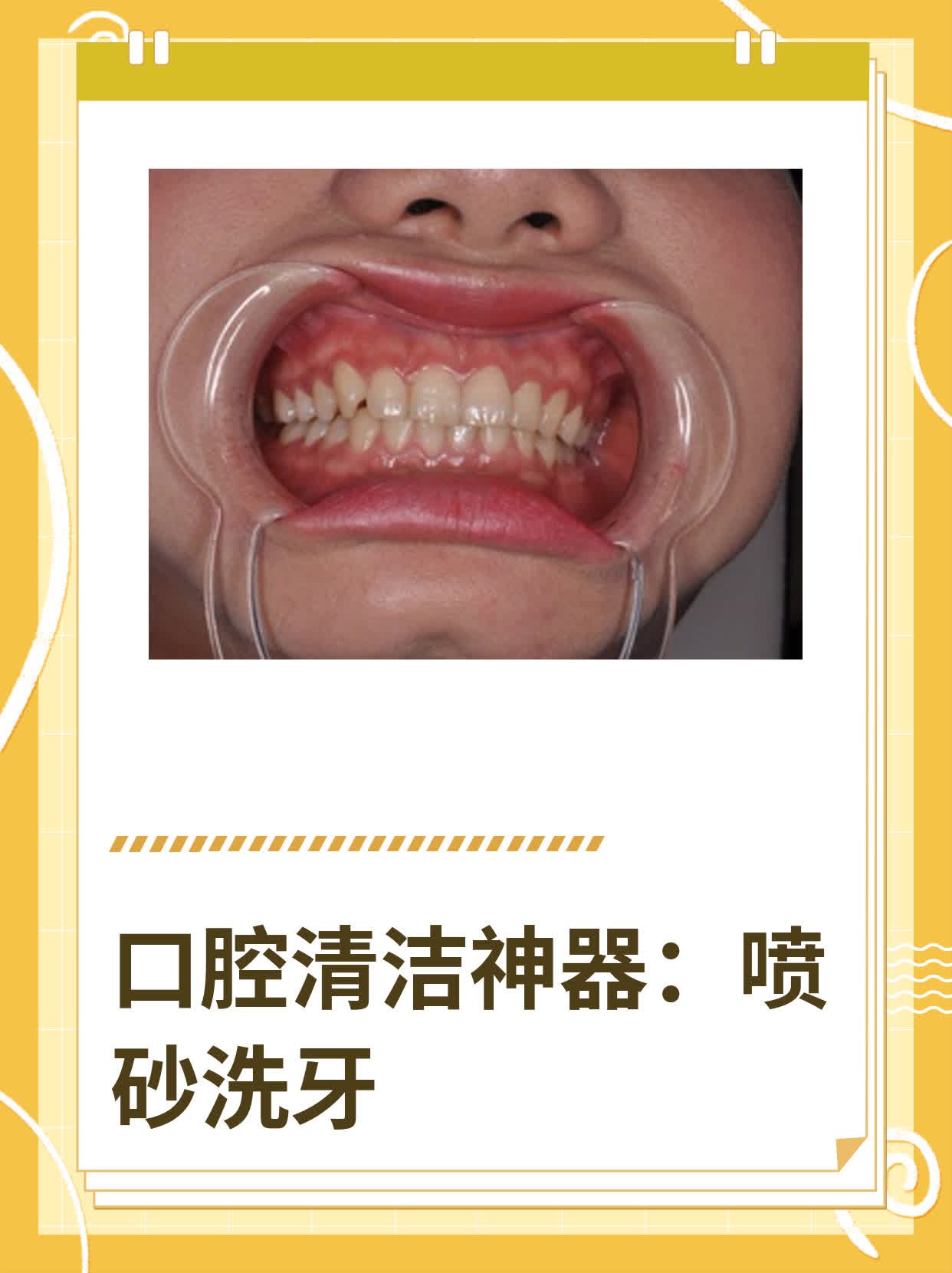 口腔清洁神器:喷砂洗牙