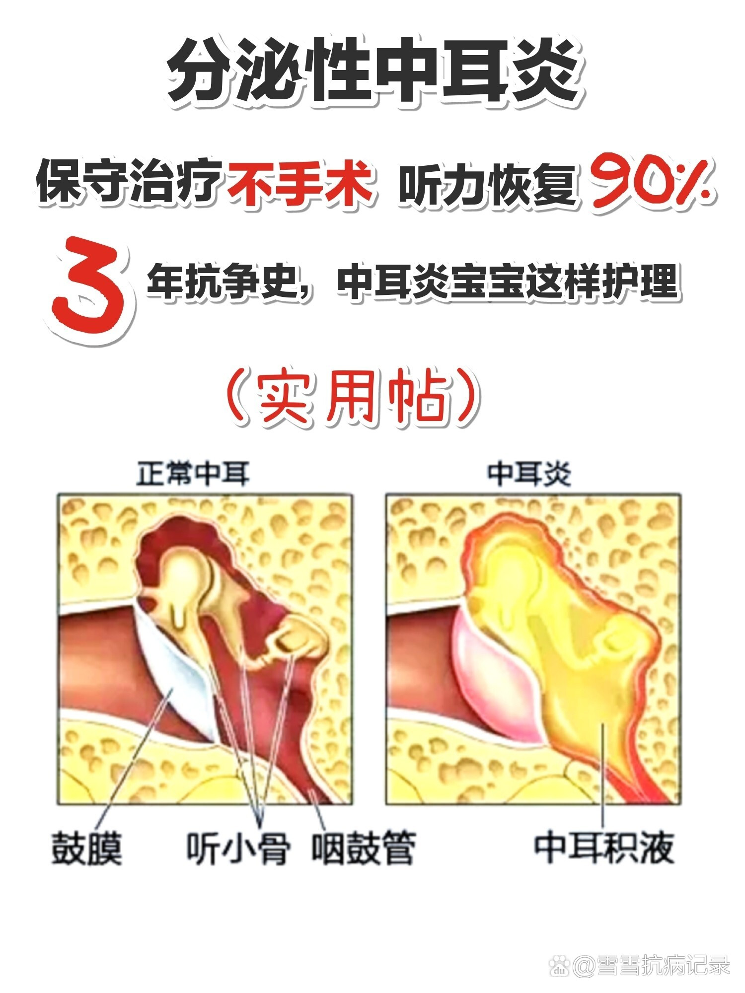 急性中耳炎怎么治疗图片