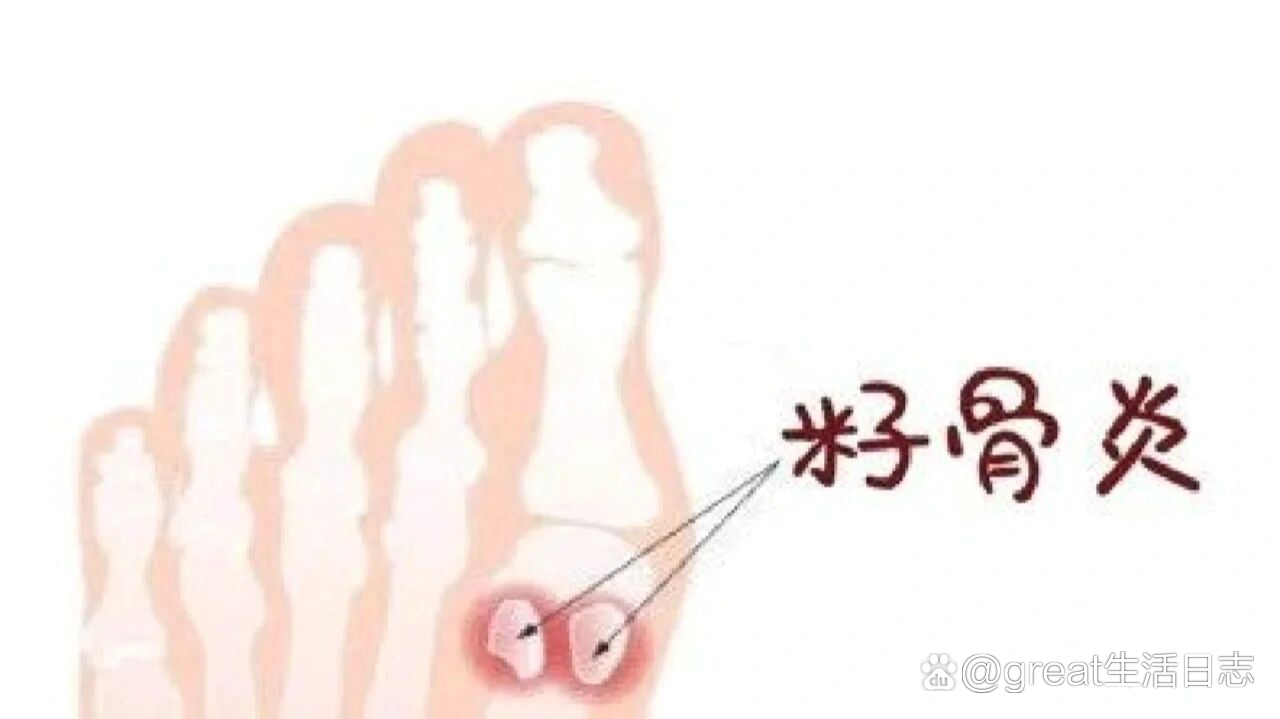 籽骨位于大脚趾底部两侧滑动的肌腱内,像两个豌豆大,是控制脚趾肌腱的