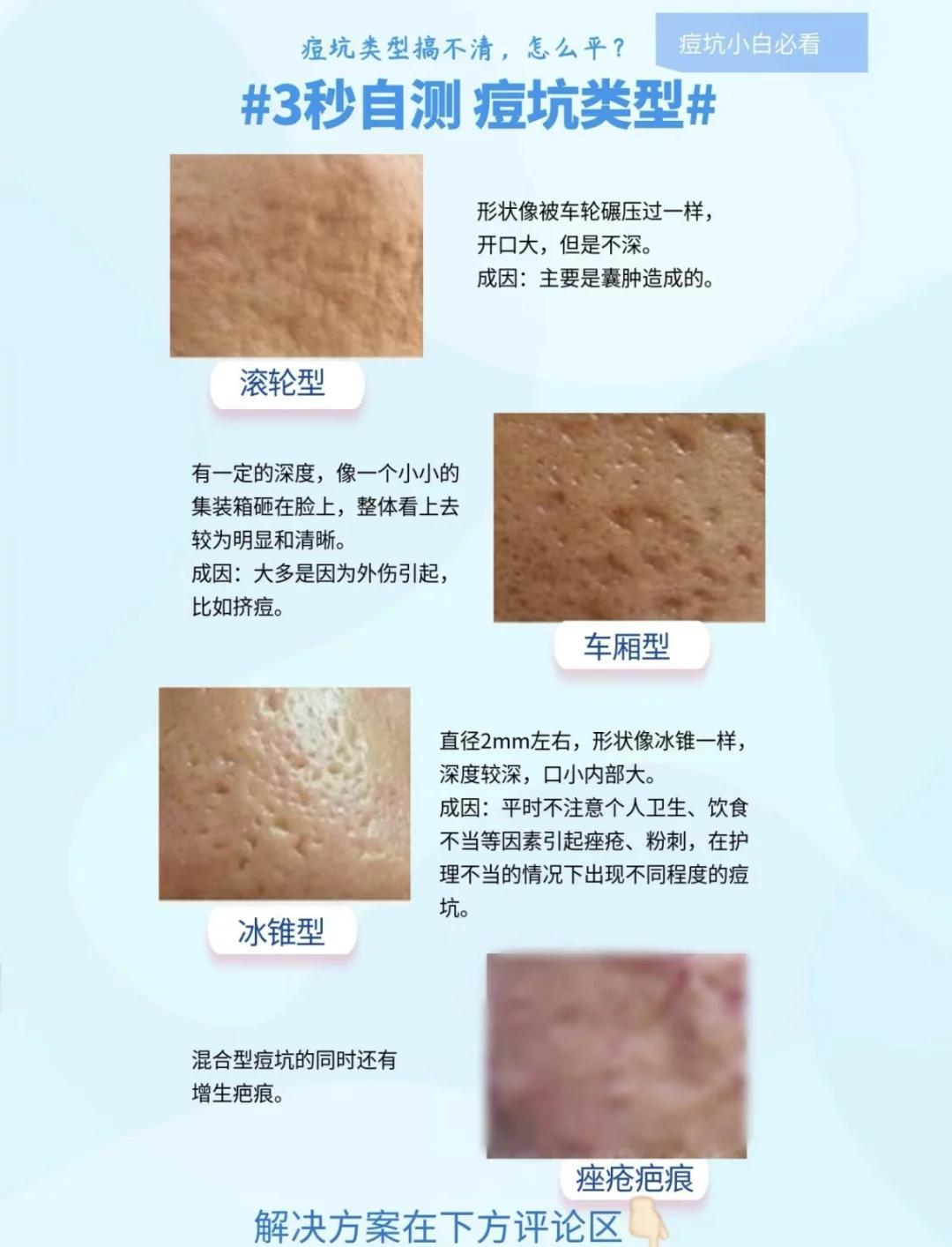 痘坑类型与治疗方法