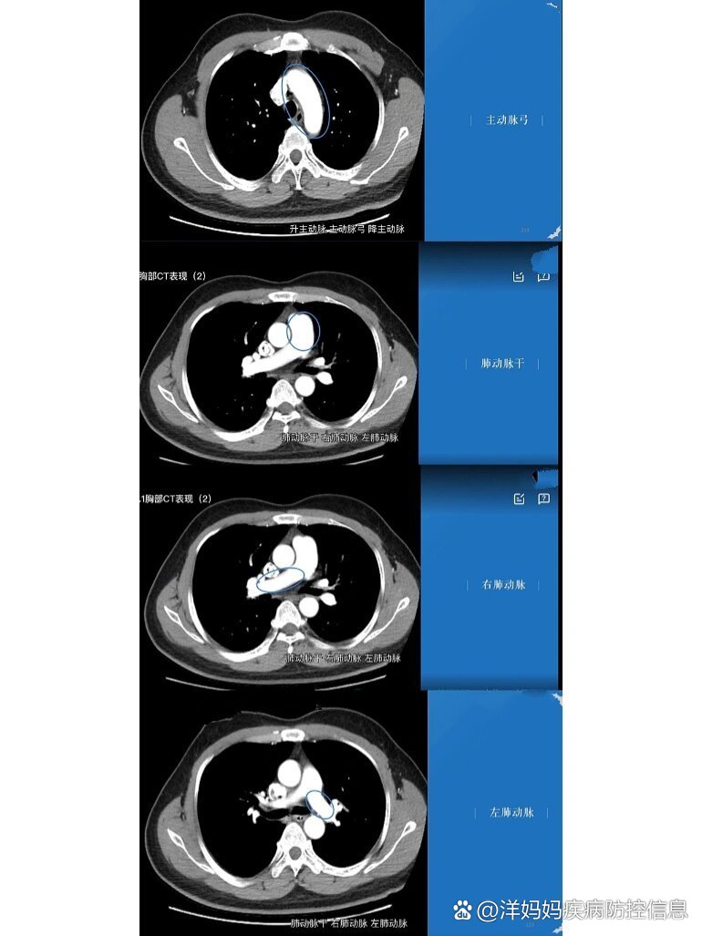 胸部ct正常图像(动脉,心腔…)