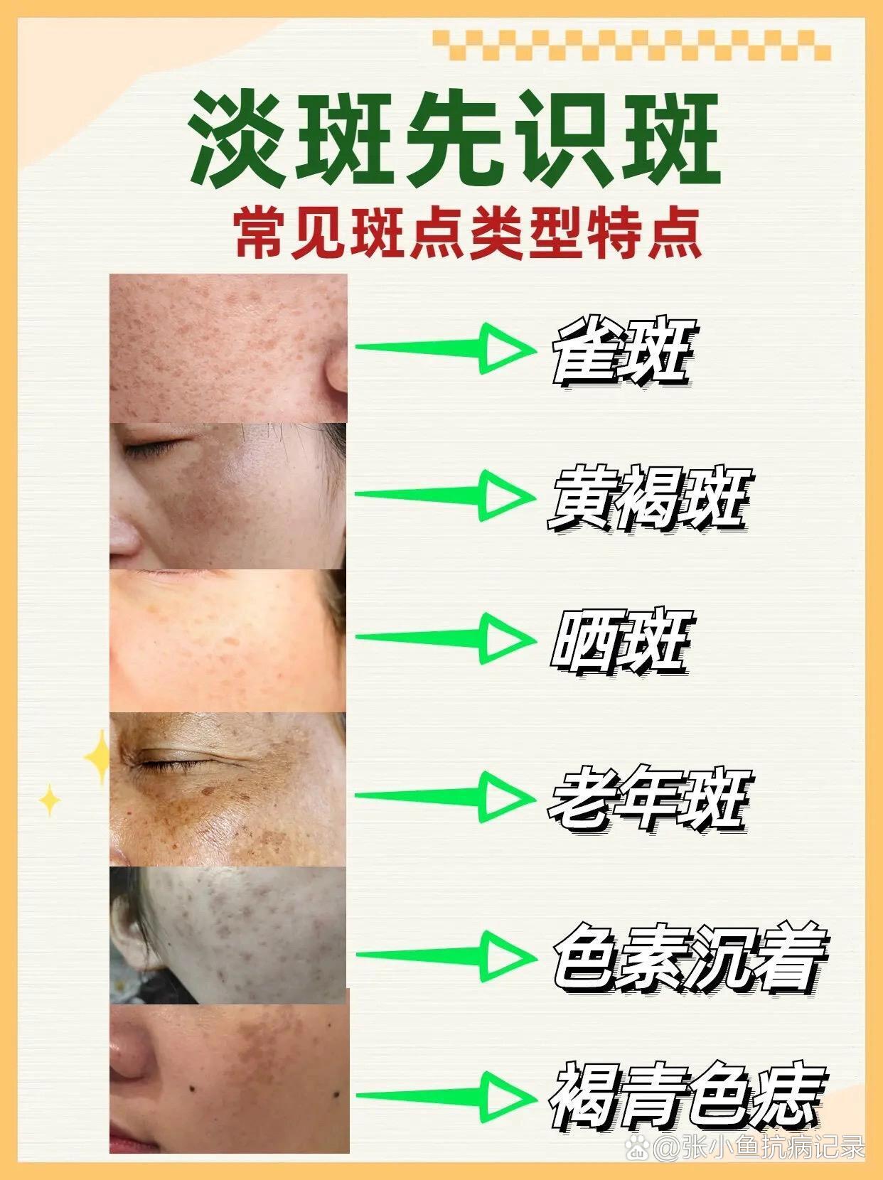 先了解自己是哪种类型的斑点,才能对症改善  br>以下是一些常见的斑点