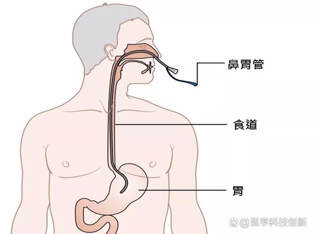 插胃管的老人要怎样护理?