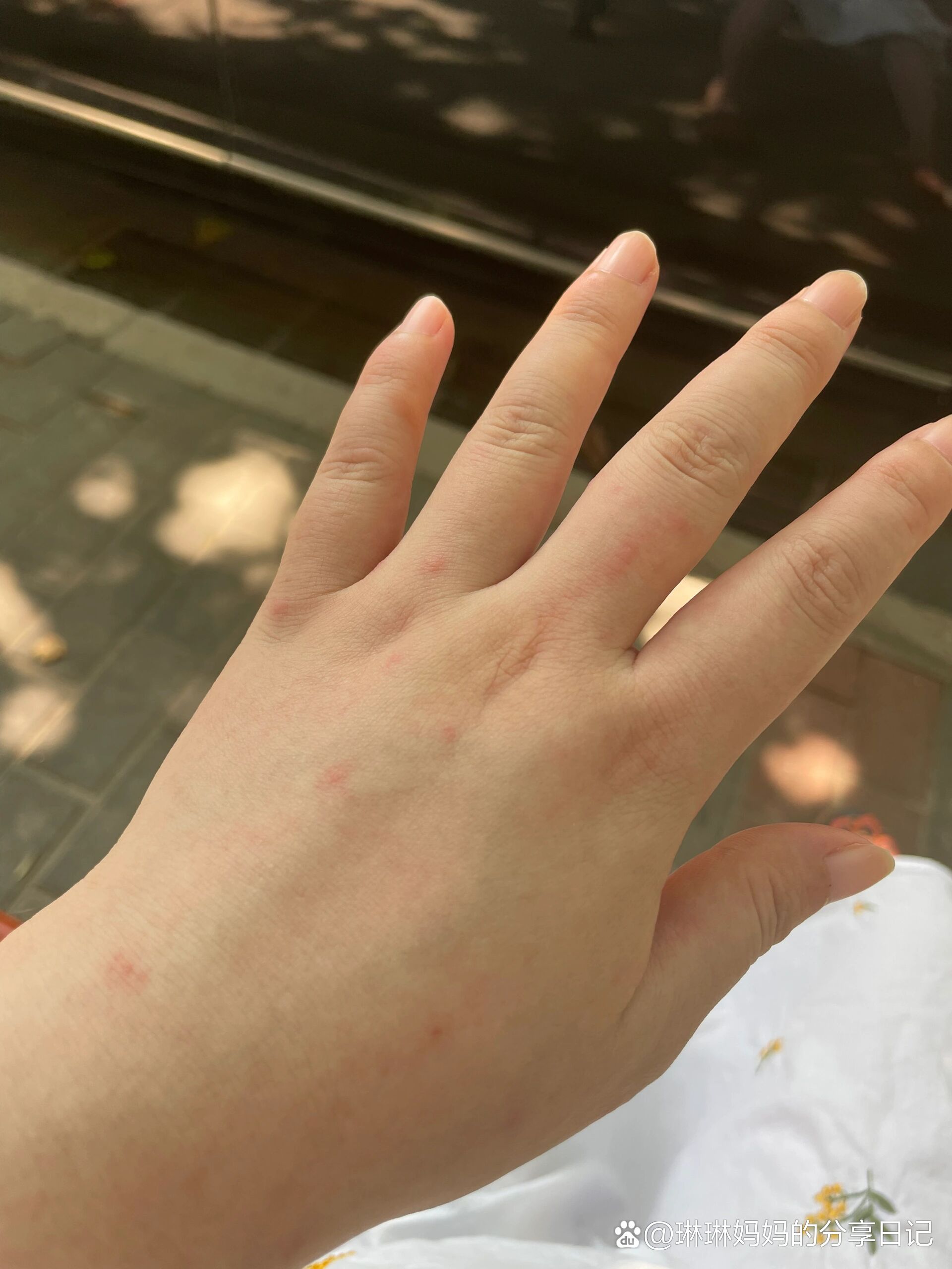 孕晚期手上脚上长了很多红点,不疼也不痒