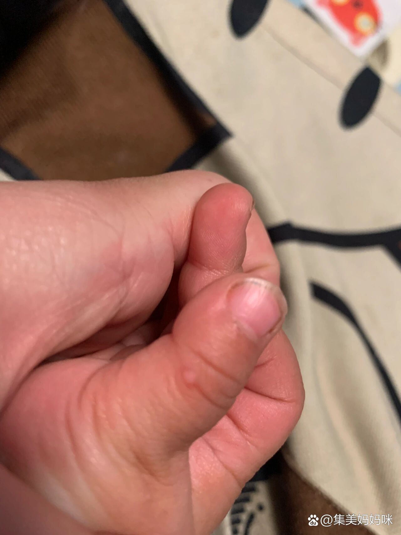 宝宝拇指关节长了颗硬硬的疙瘩