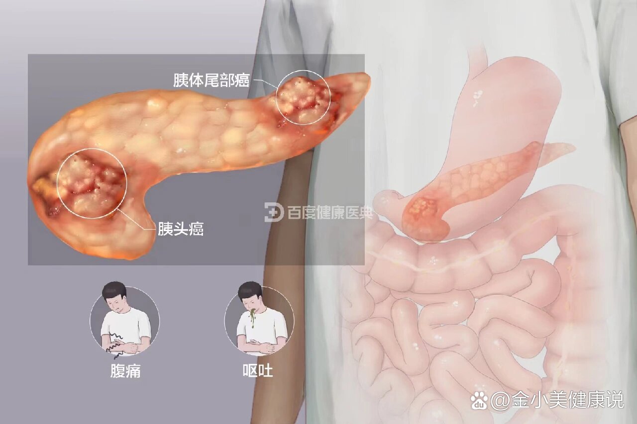 确诊胰腺癌早期