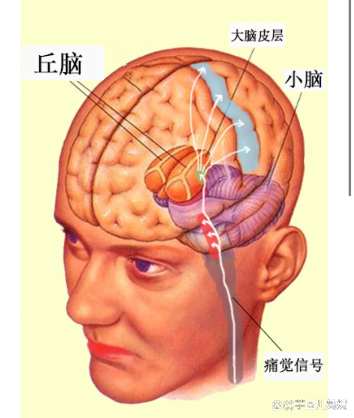 丘脑钙化图片