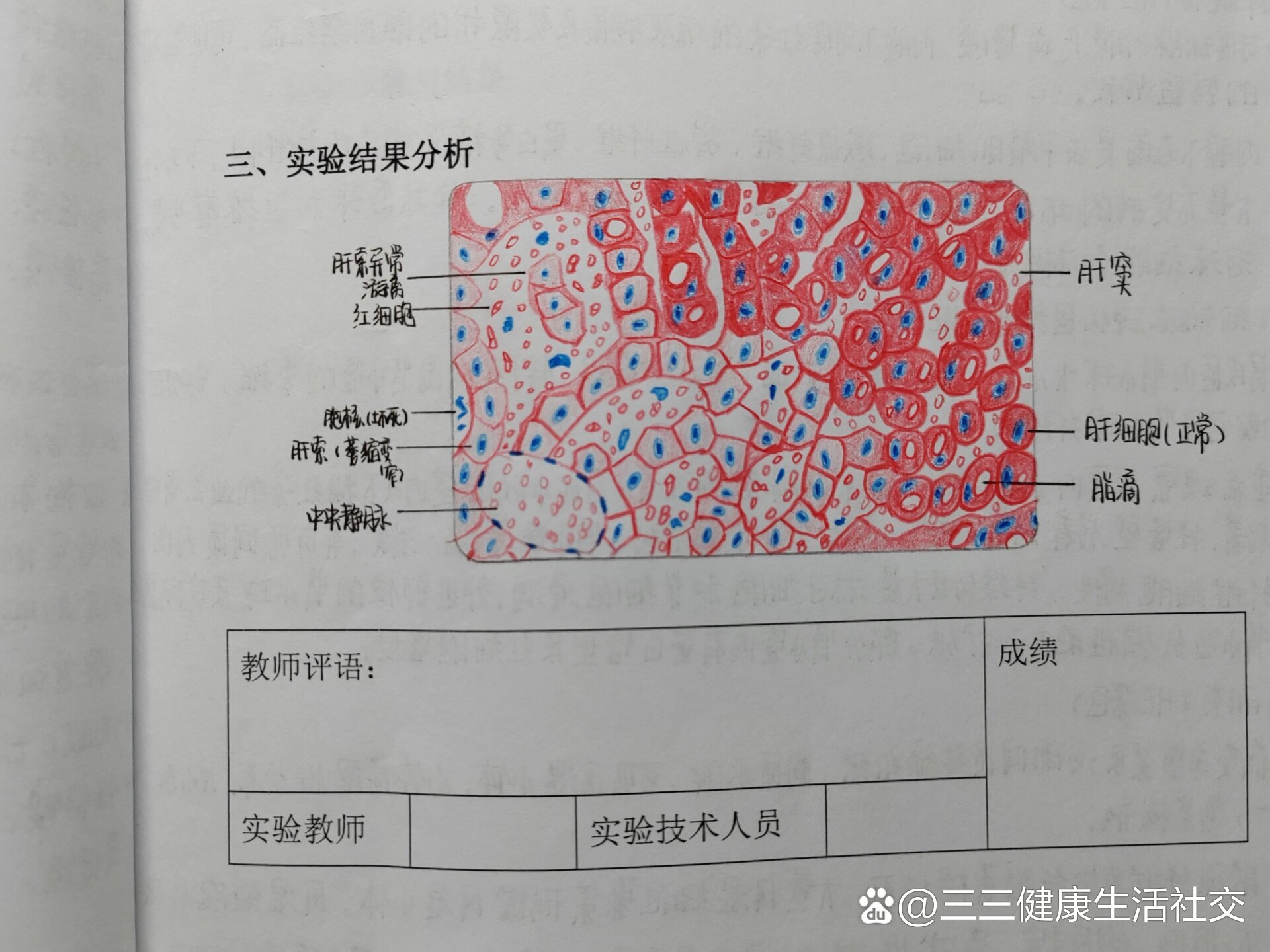 肝淤血大体手绘图图片