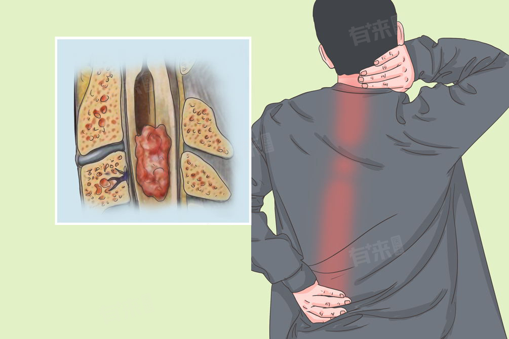 视神经脊髓炎什么症状