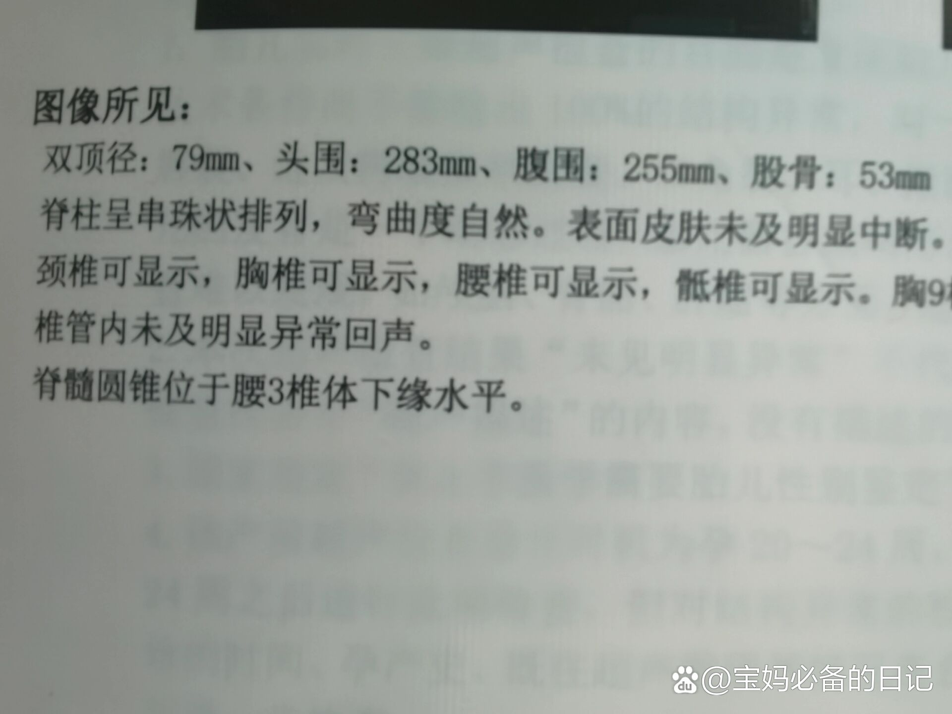 胎儿脊髓圆锥位置低