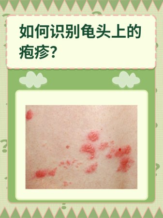 如何识别龟头上的疱疹？