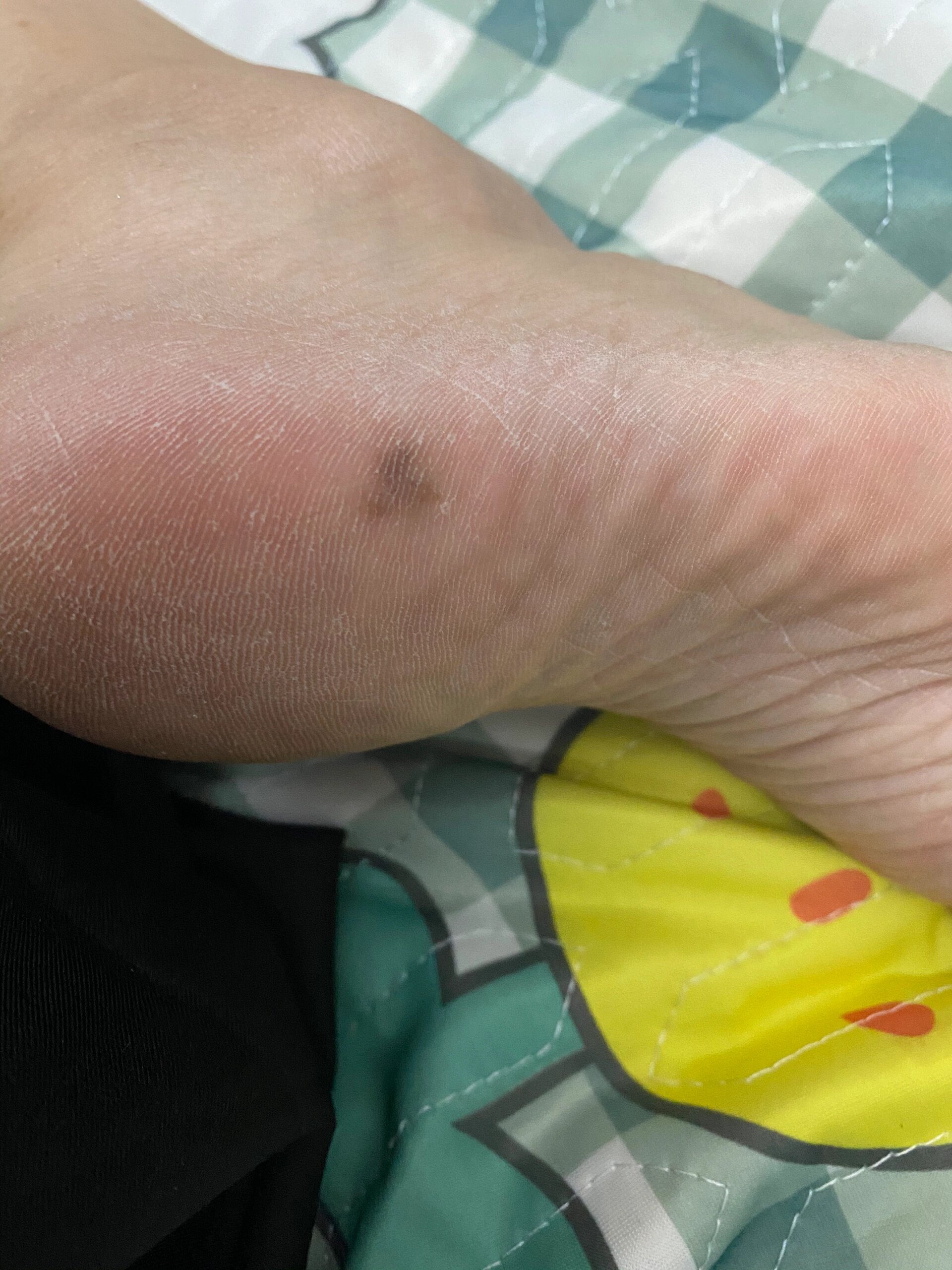 脚底黑色素沉淀需要手术吗