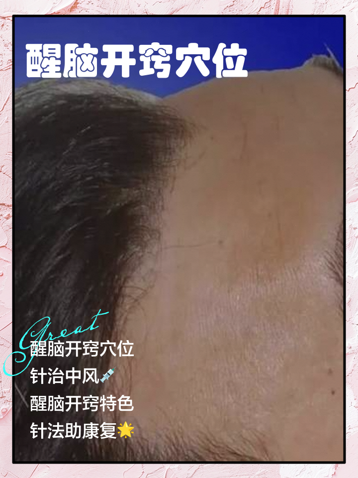 醒脑开窍针刺法