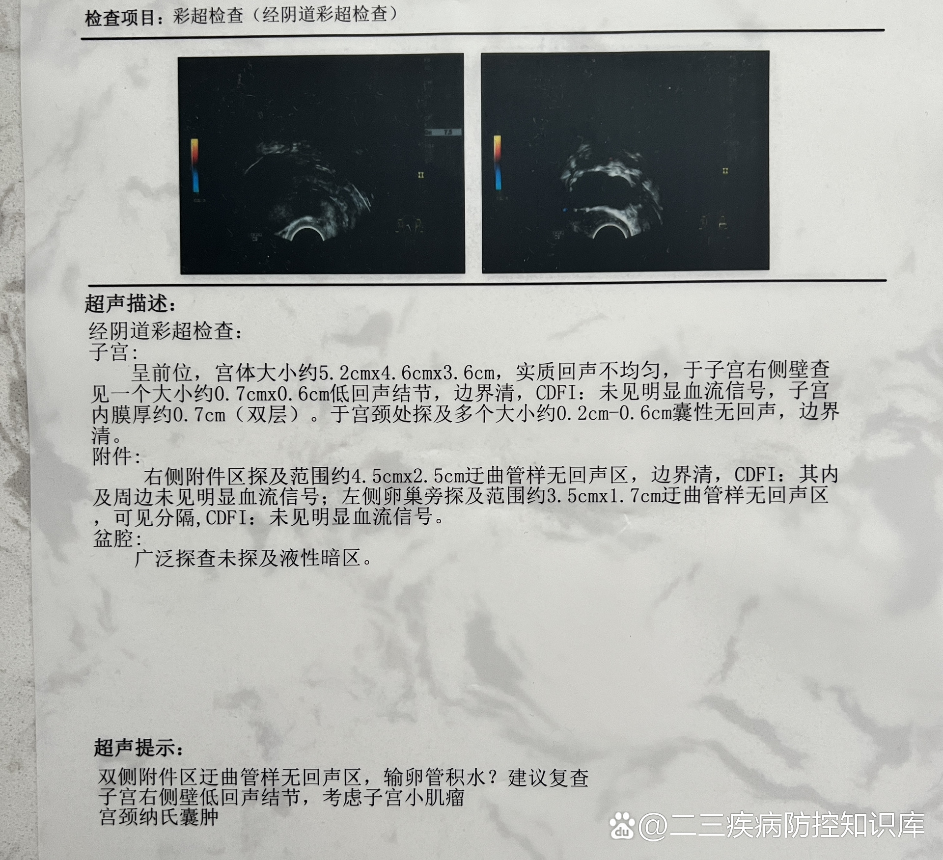 双侧输卵管积水,腹腔镜手术